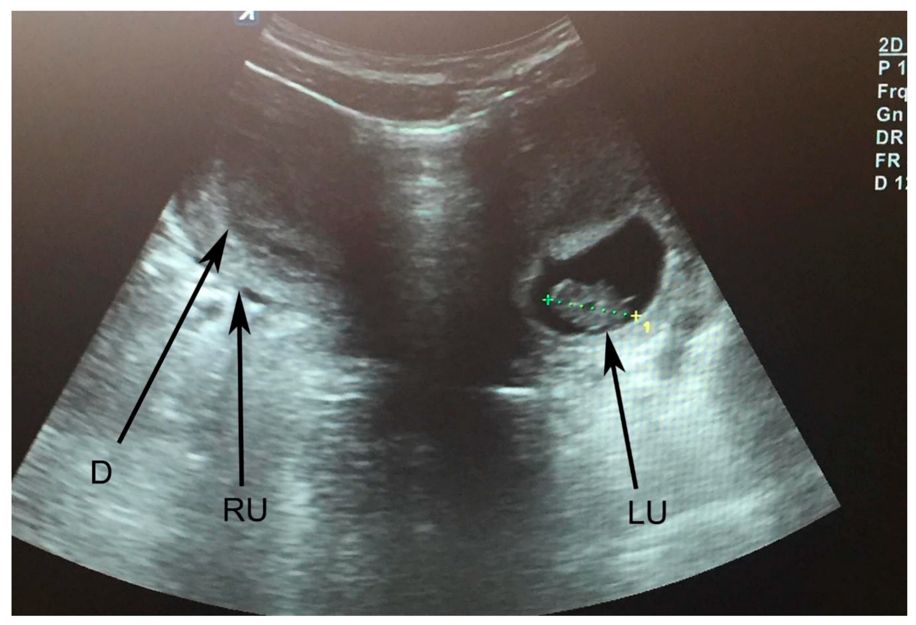 And pregnancy uterus Bicornuate Uterus