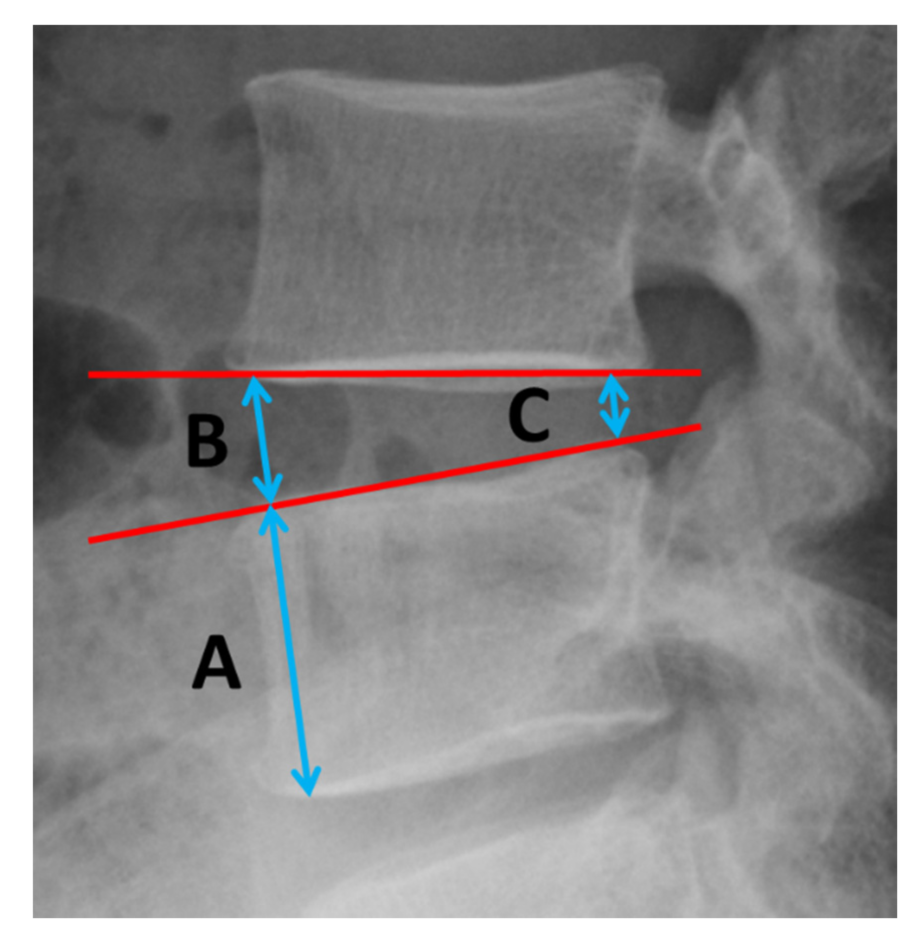 Medicina Free FullText FullEndoscopic Lumbar Interbody Fusion for
