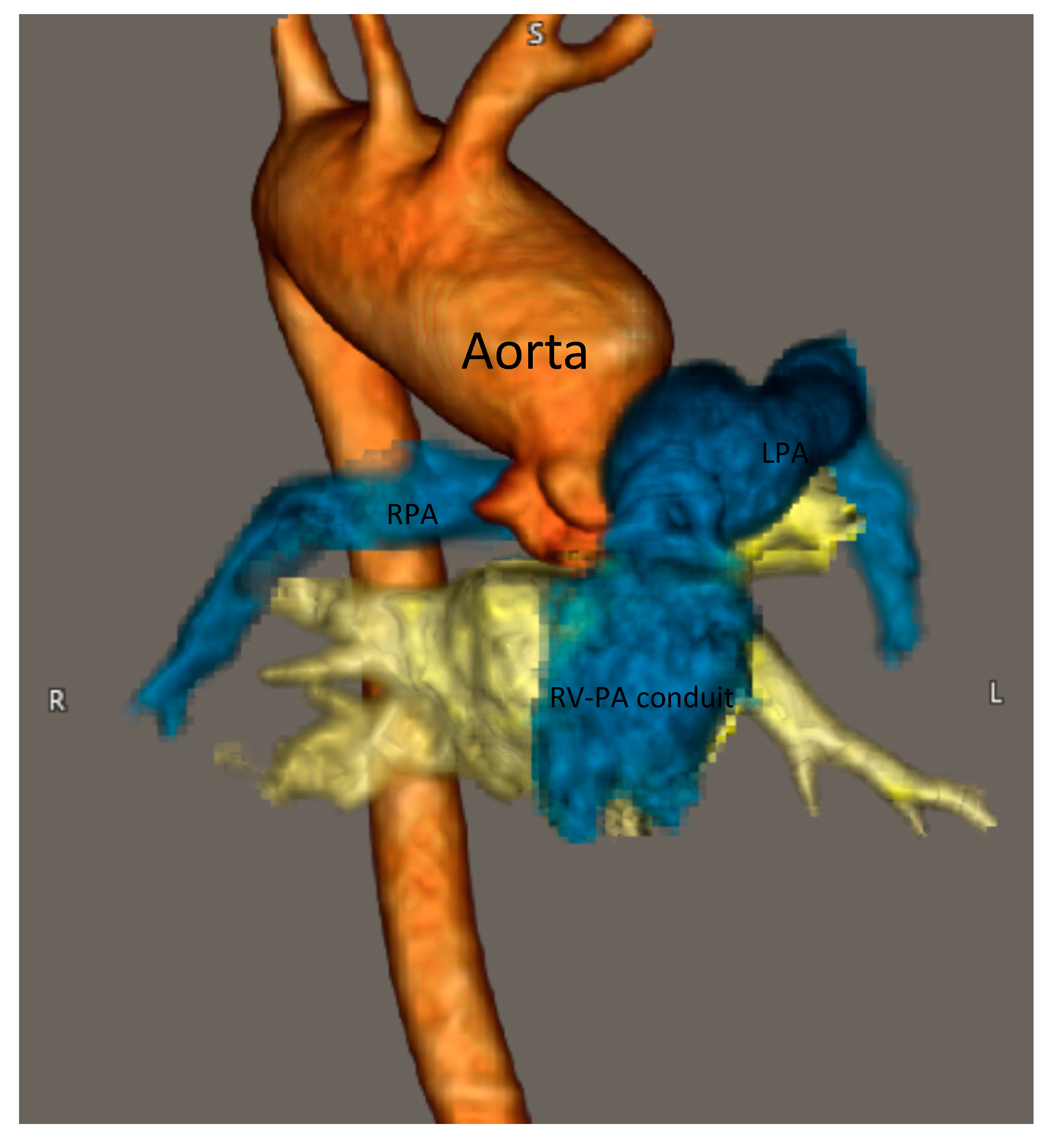 Medicina | Free Full-Text | Segmental Pulmonary Hypertension in Children with Congenital Heart Disease Medicina | Free Full-Text | Segmental Pulmonary Hypertension in Children with Congenital Heart Disease
