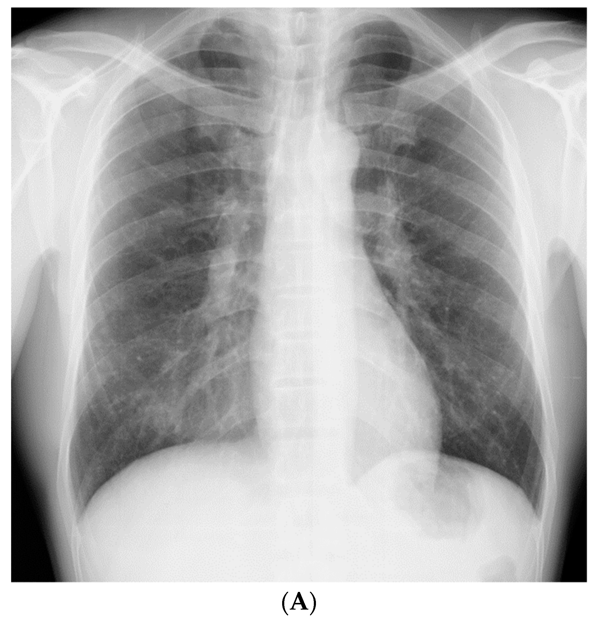 Cases Of Berylliosis