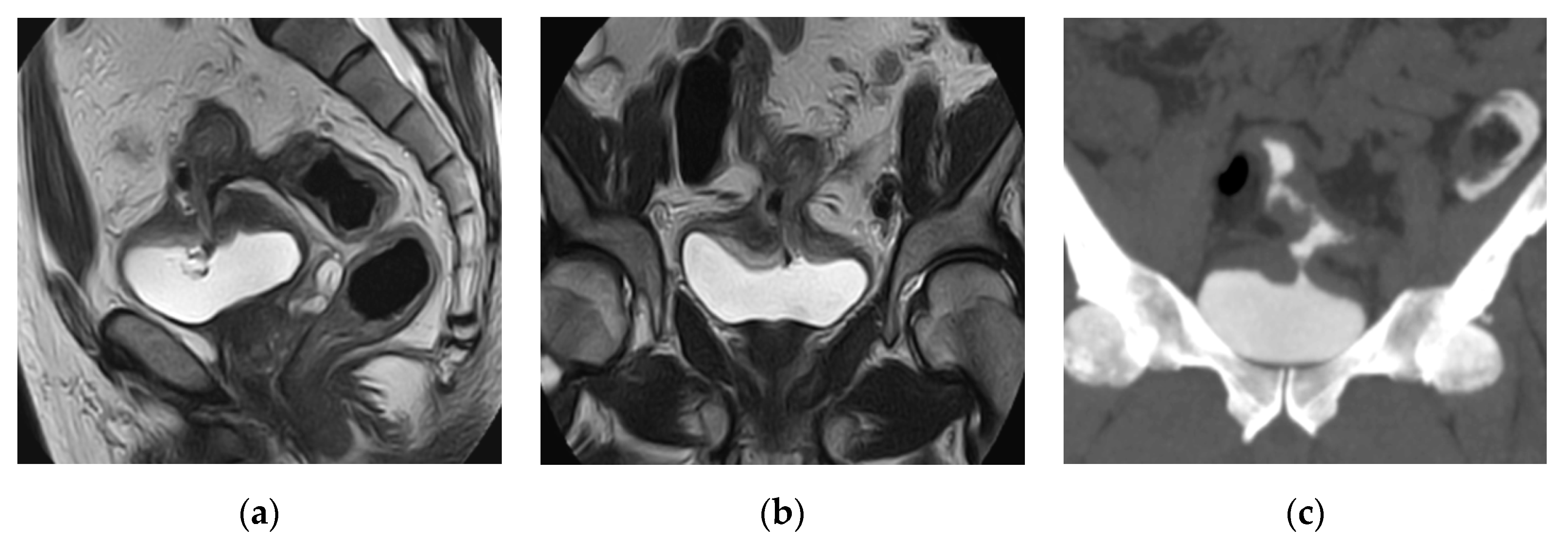 Prostatitis és fistula)