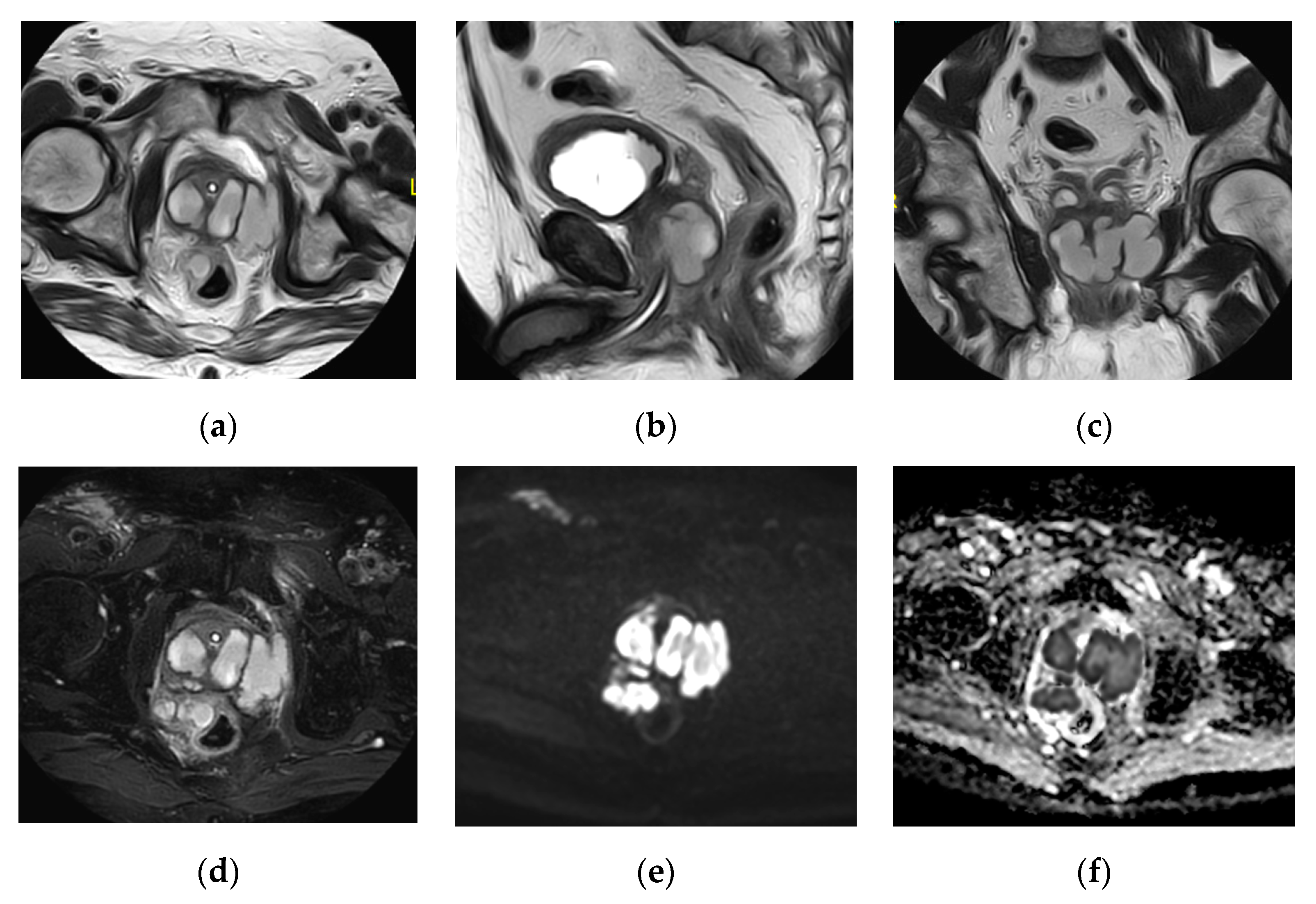 Prostatitis és MRI)