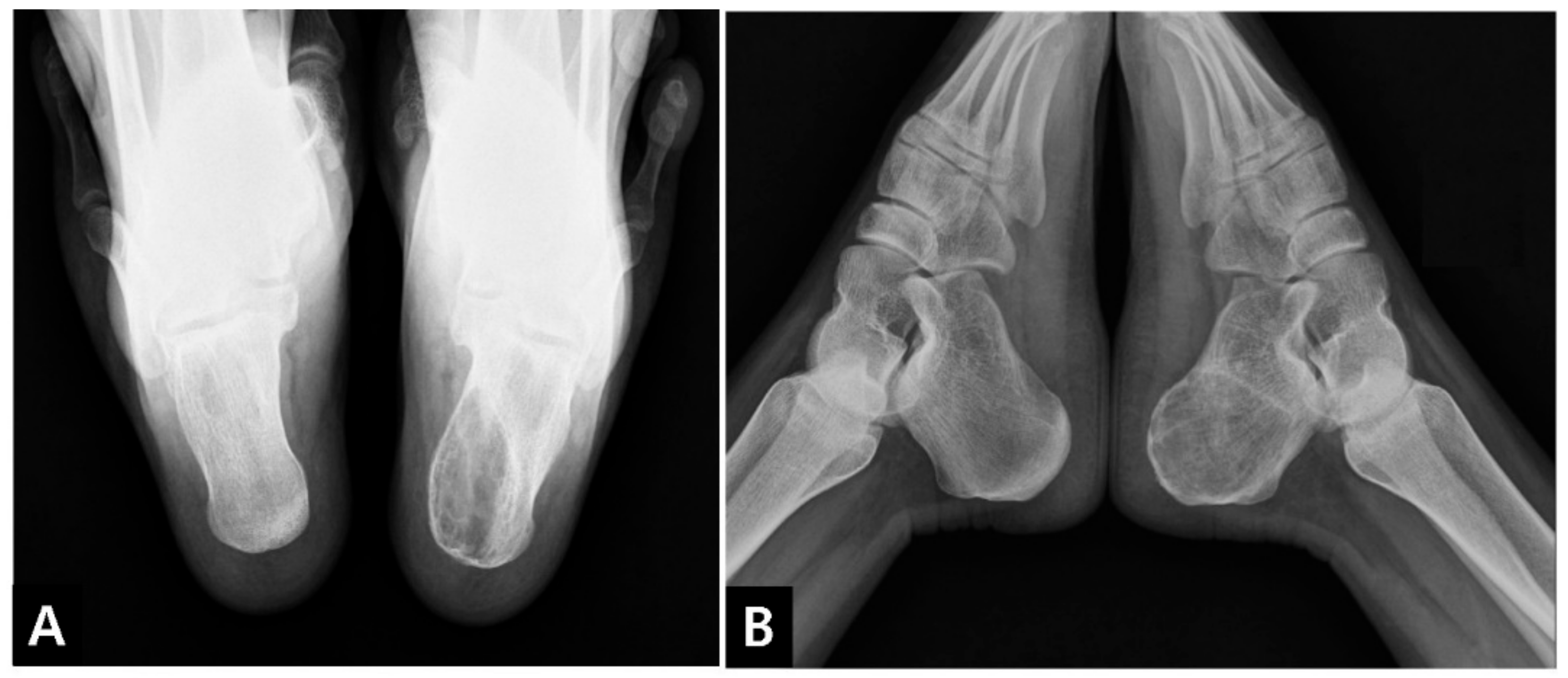 unicameral-bone-cyst-calcaneus-surgery