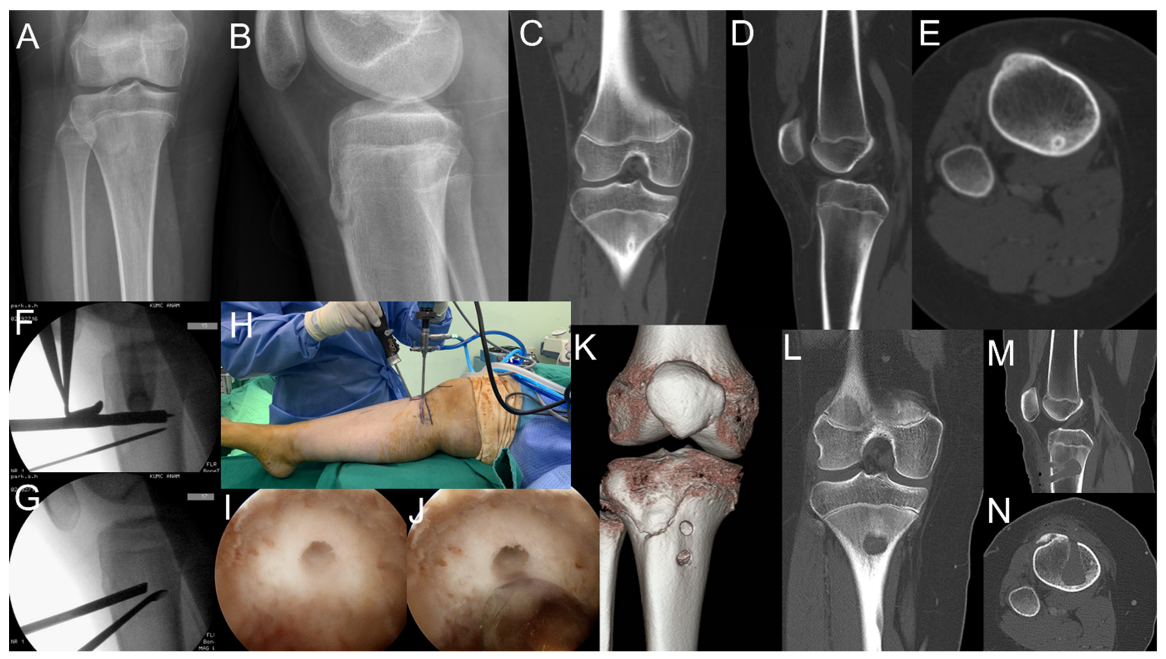 Medicina Free Full Text Excision Of Intramedullary Osteoid Osteomas In The Posterior Tibial Area Via Medulloscopy A Case Report Html