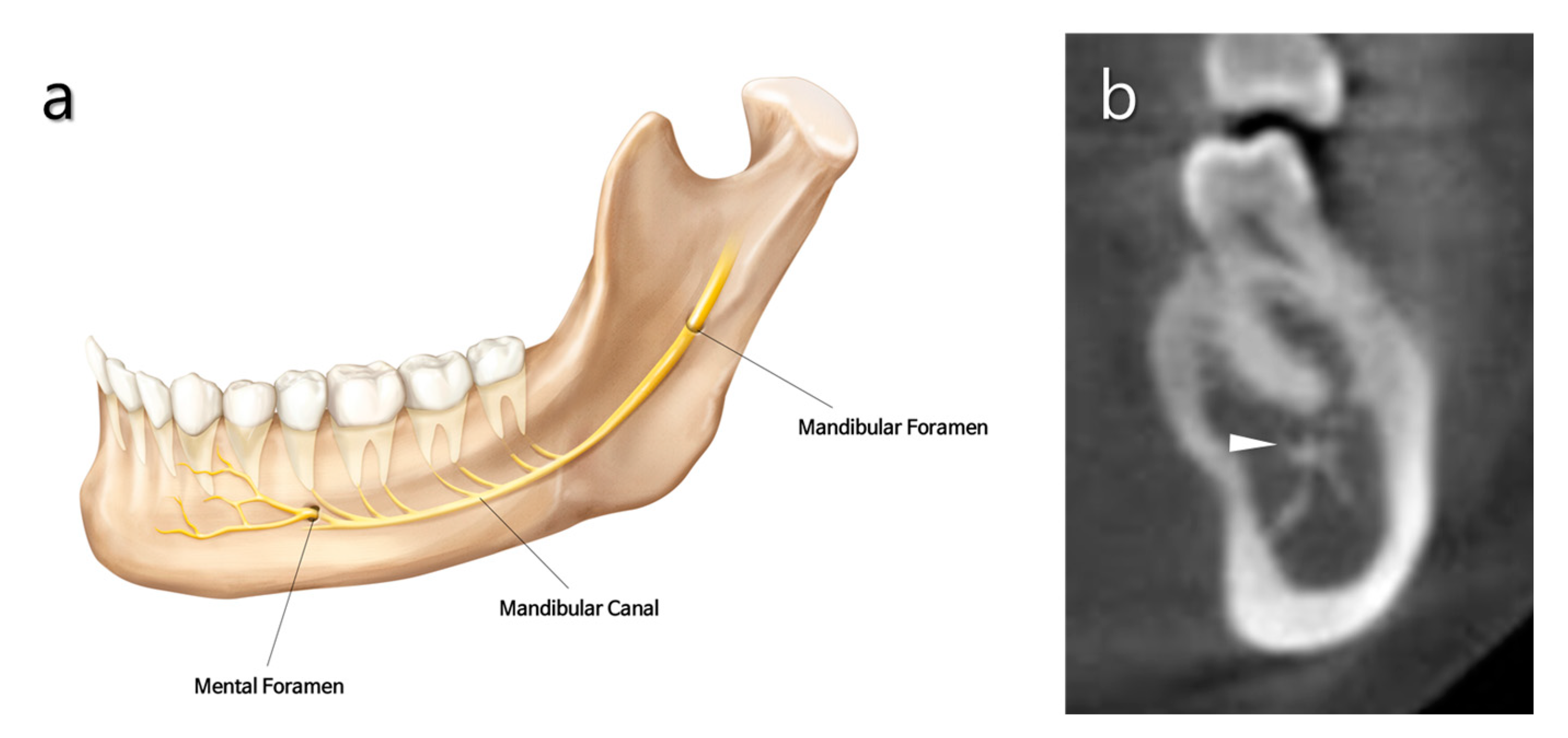 Medicina Free Full Text An Update On Endodontic Microsurgery Of Mandibular Molars A Focused Review Html