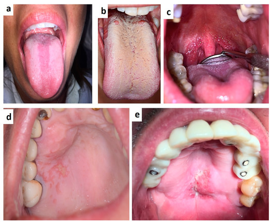 papillomatosis florida oris