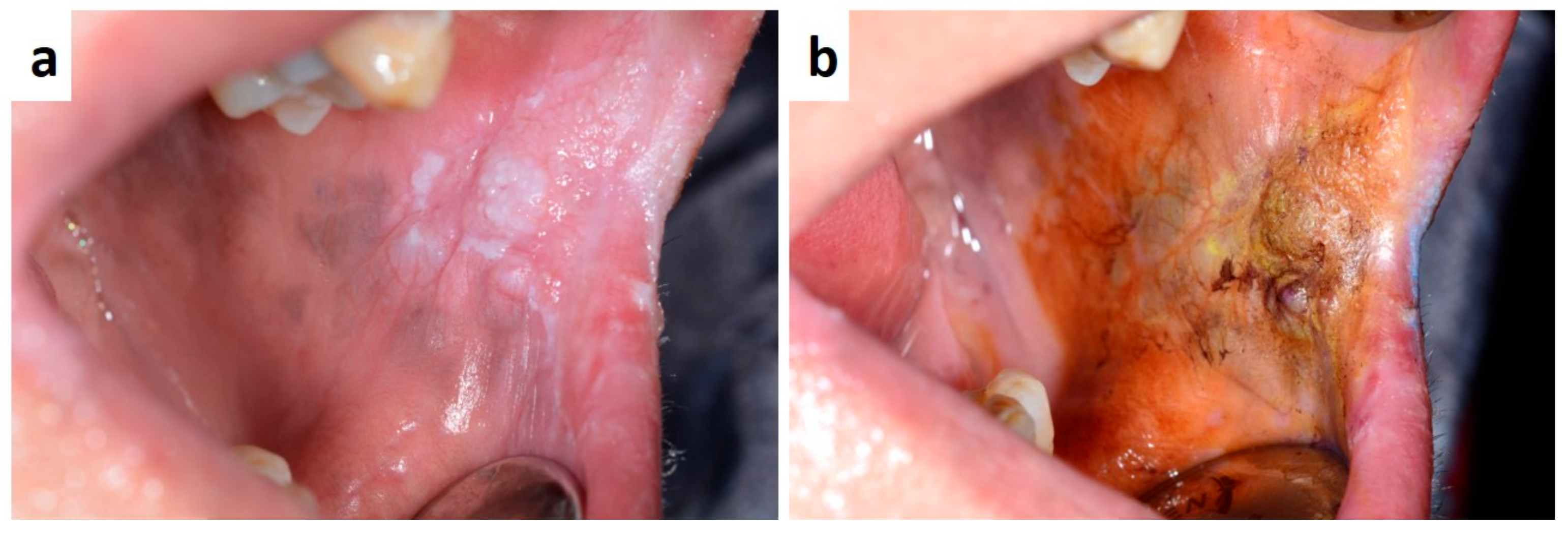 Papillomatosis florida oris. Sesiuni de vindecare ale oris. tratamentul prostatitei