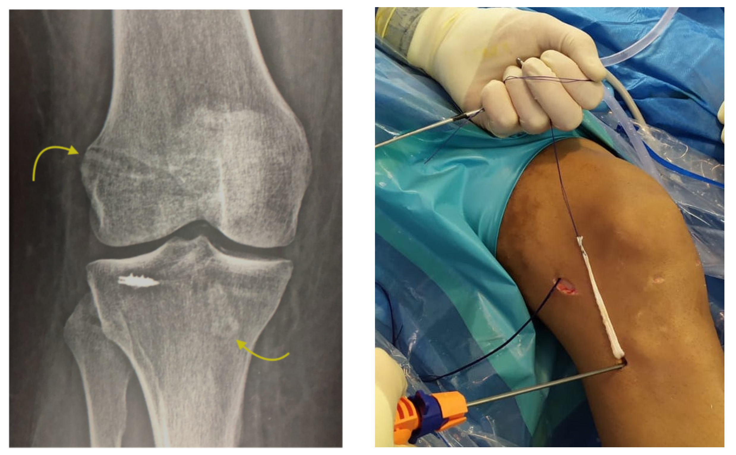 tibia mc 8.6 tibia mc 8.6