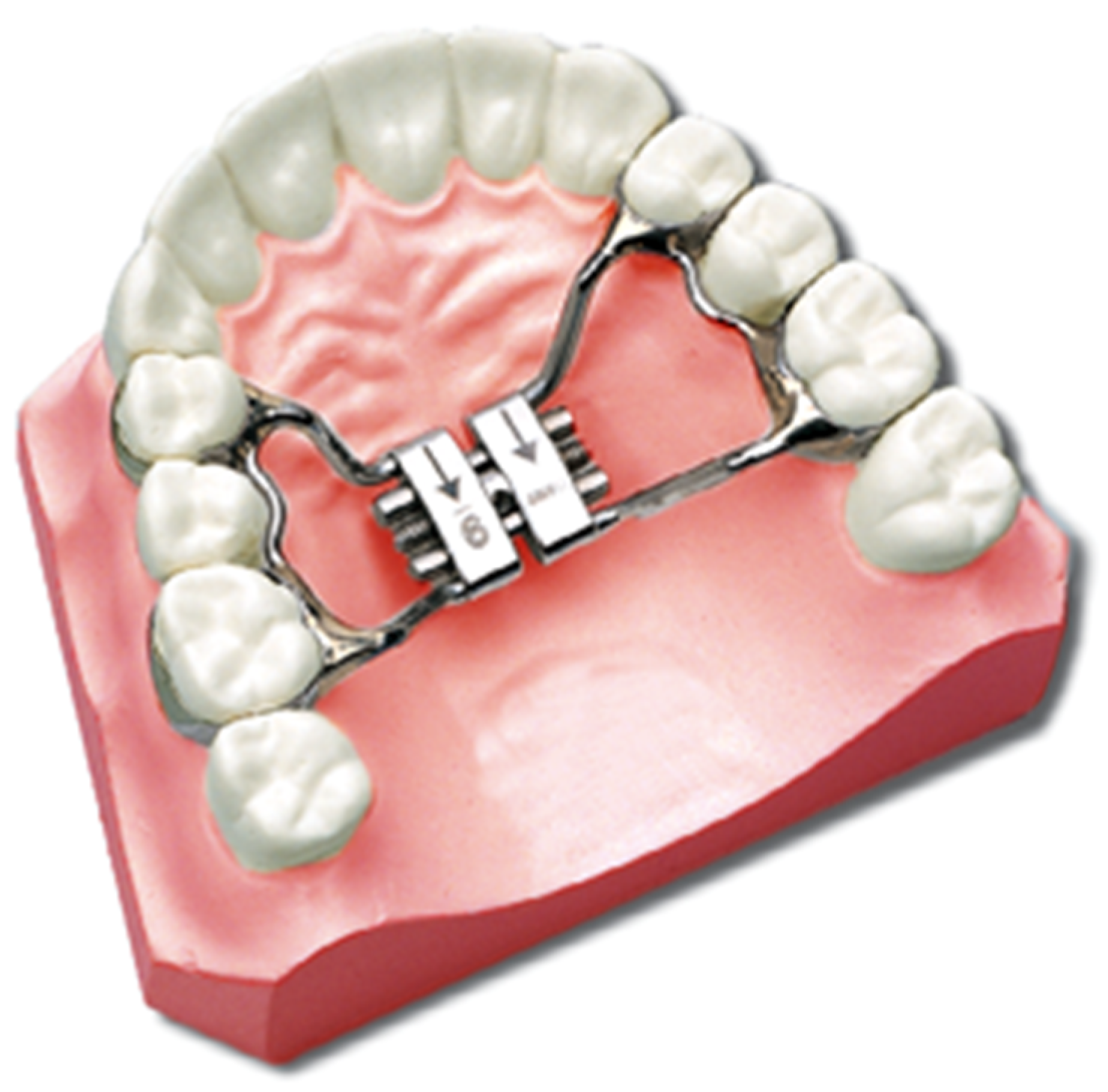 Hyrax Appliance Rapid Maxillary Expansion