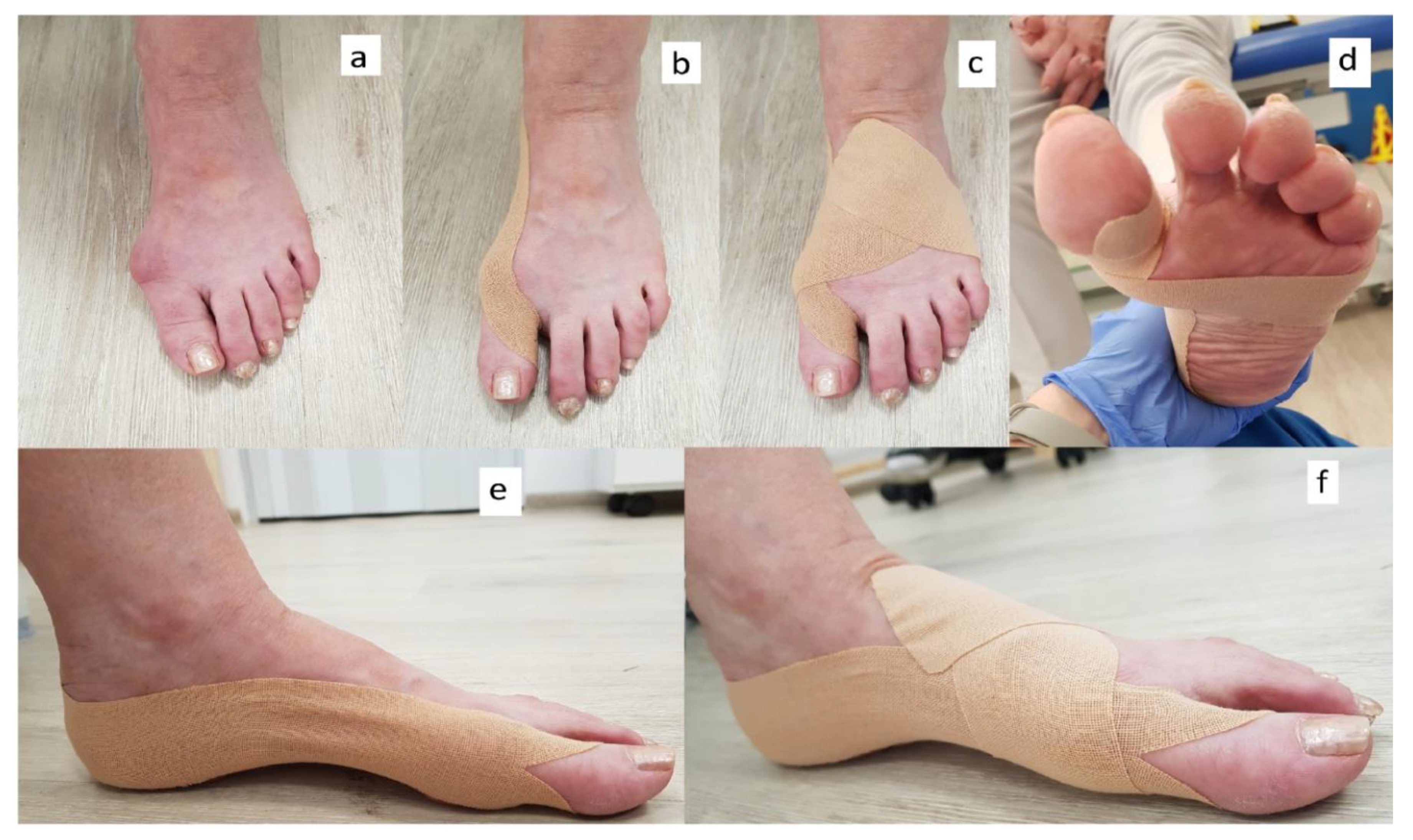 Taping for deals arch support