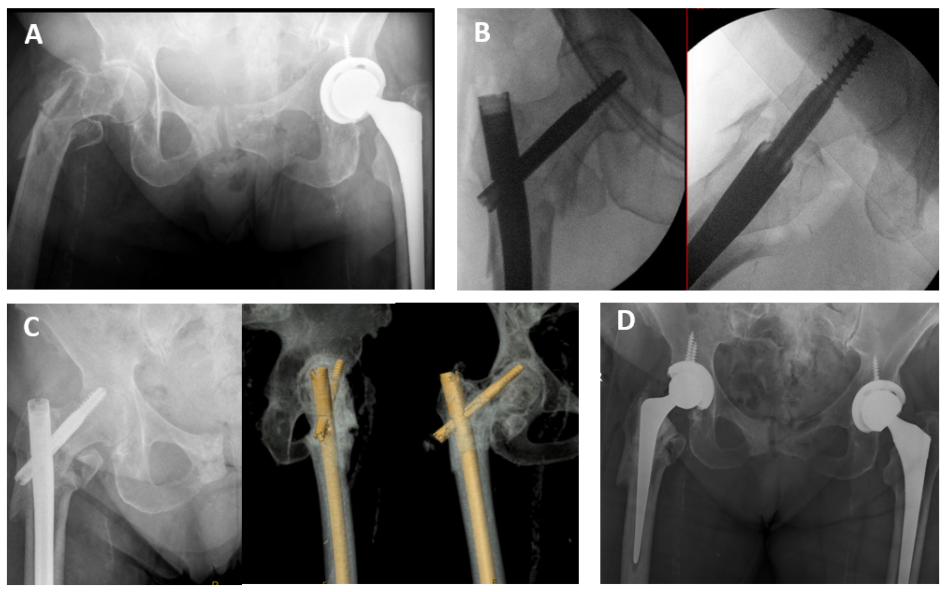 Medicina | Free Full-Text | Medial Calcar Comminution and Intramedullary  Nail Failure in Unstable Geriatric Trochanteric Hip Fractures