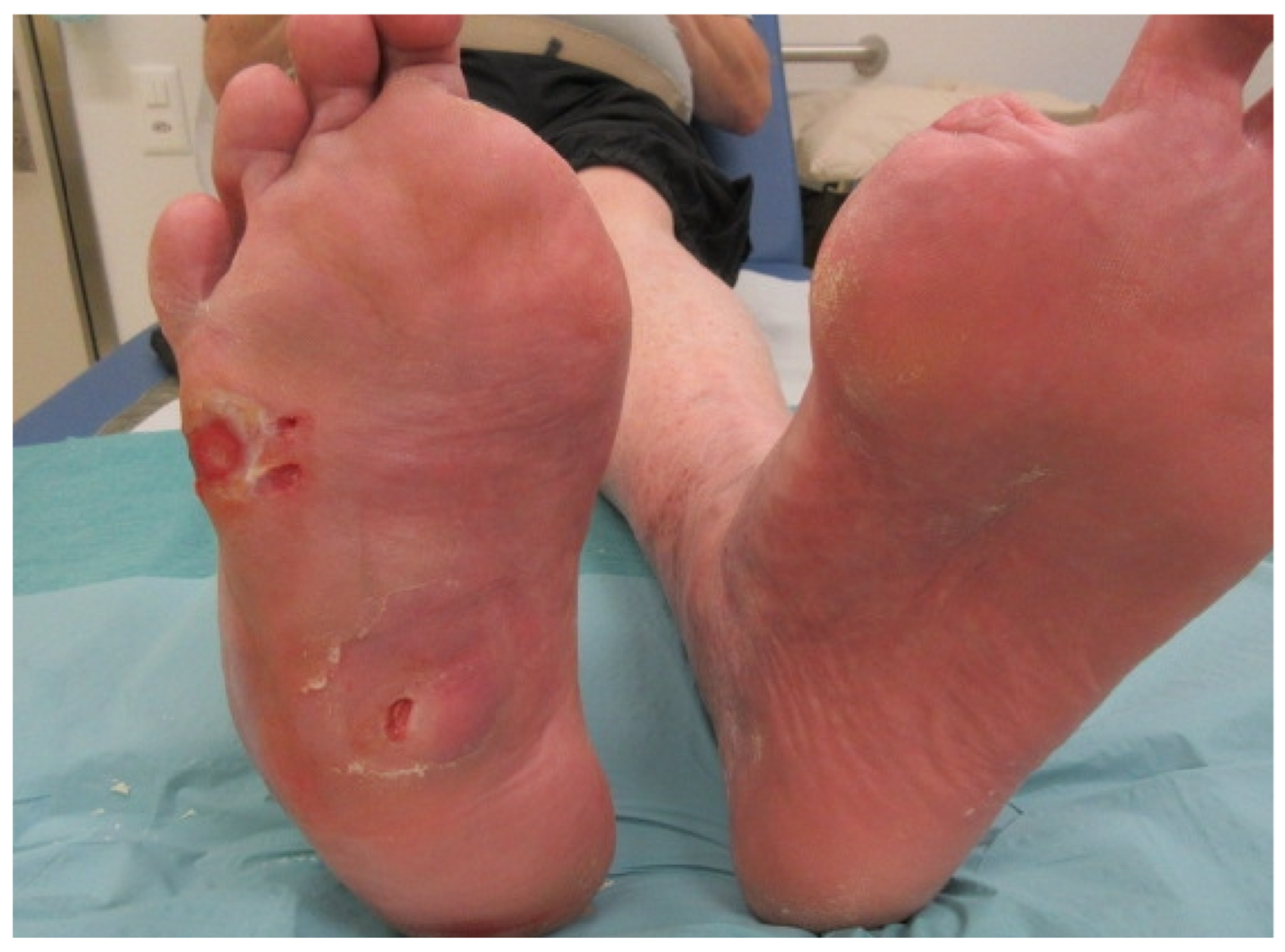diabetic foot ulcer with osteomyelitis)
