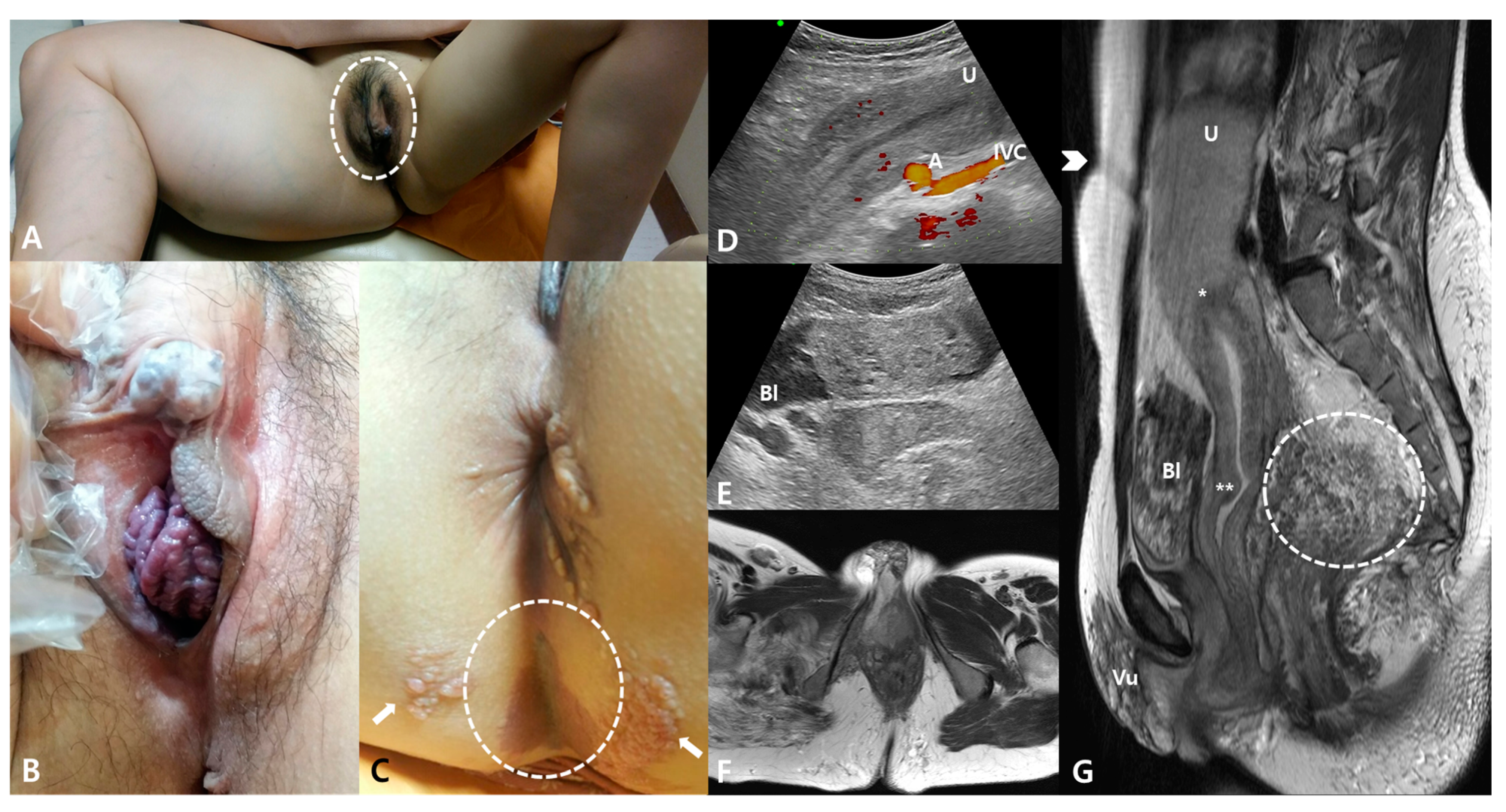 Medicina | Free Full-Text | Clitoromegaly, Vulvovaginal Hemangioma  Mimicking Pelvic Organ Prolapse, and Heavy Menstrual Bleeding: Gynecologic  Manifestations of Klippel-Trénaunay Syndrome