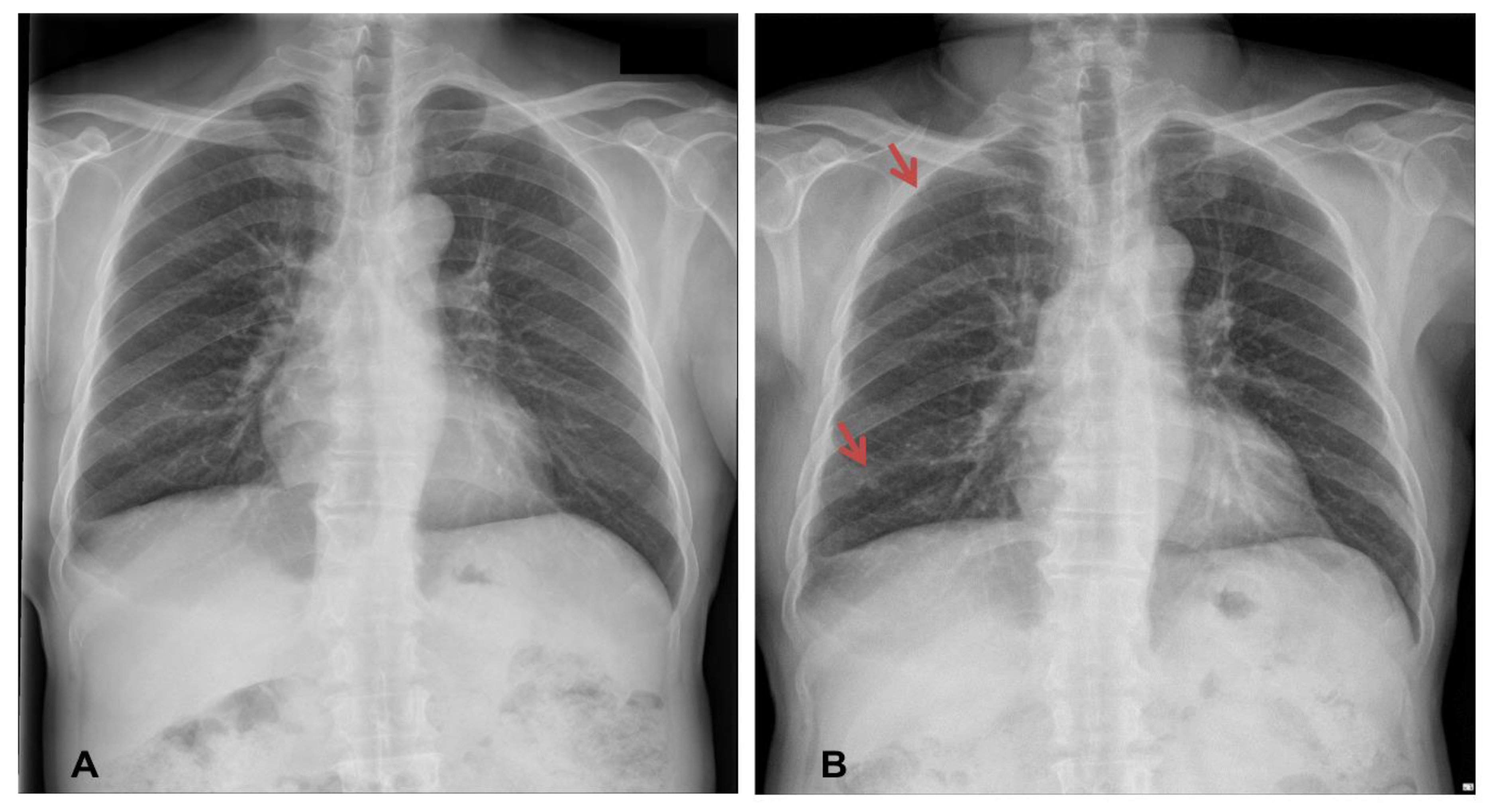 51+ Can asbestos cause breast cancer