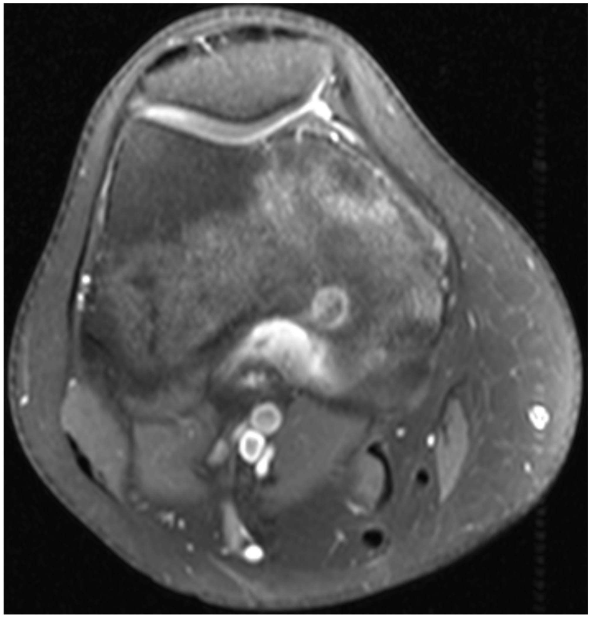 Medicina Free Full Text Osteoid Osteoma Treatment With Microwave Ablation A Report Of Two Cases Html