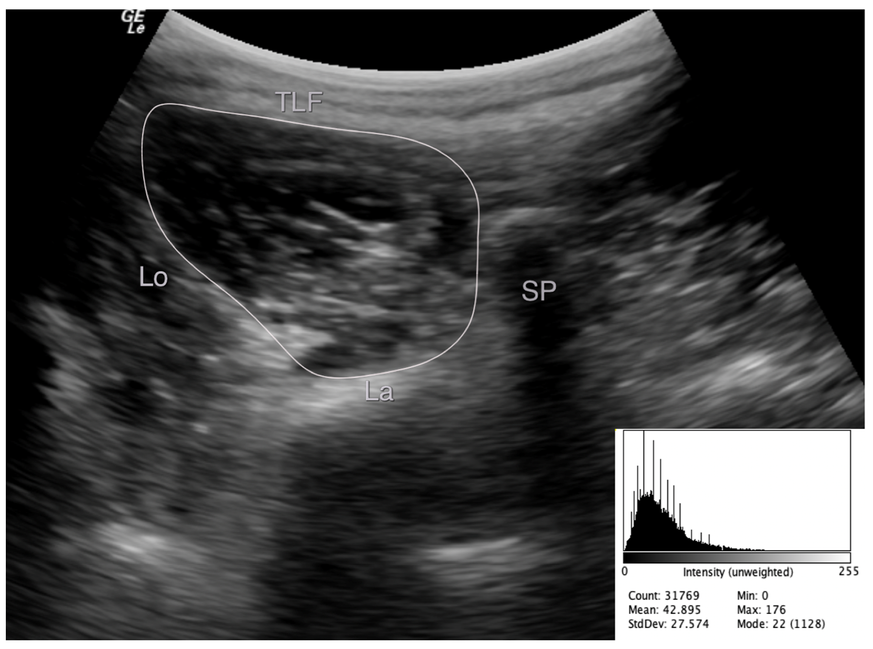 Medicina Free Full Text Ultrasound Imaging Analysis Of The Lumbar Multifidus Muscle Echo Intensity Intra Rater And Inter Rater Reliability Of A Novice And An Experienced Rater Html