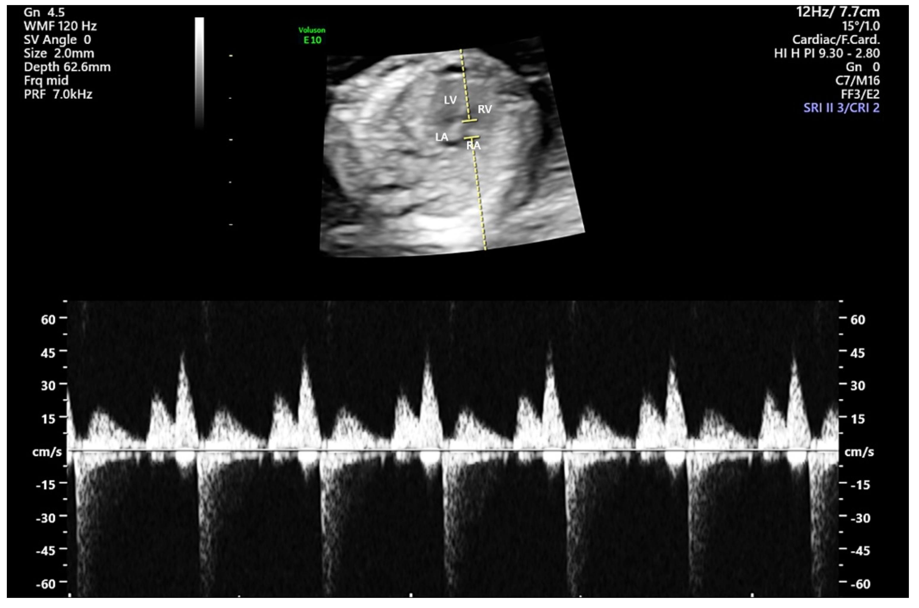 Medicina Free Full Text Mild Fetal Tricuspid Regurgitation In The medicina-free-full-text-mild-fetal-tricuspid-regurgitation-in-the