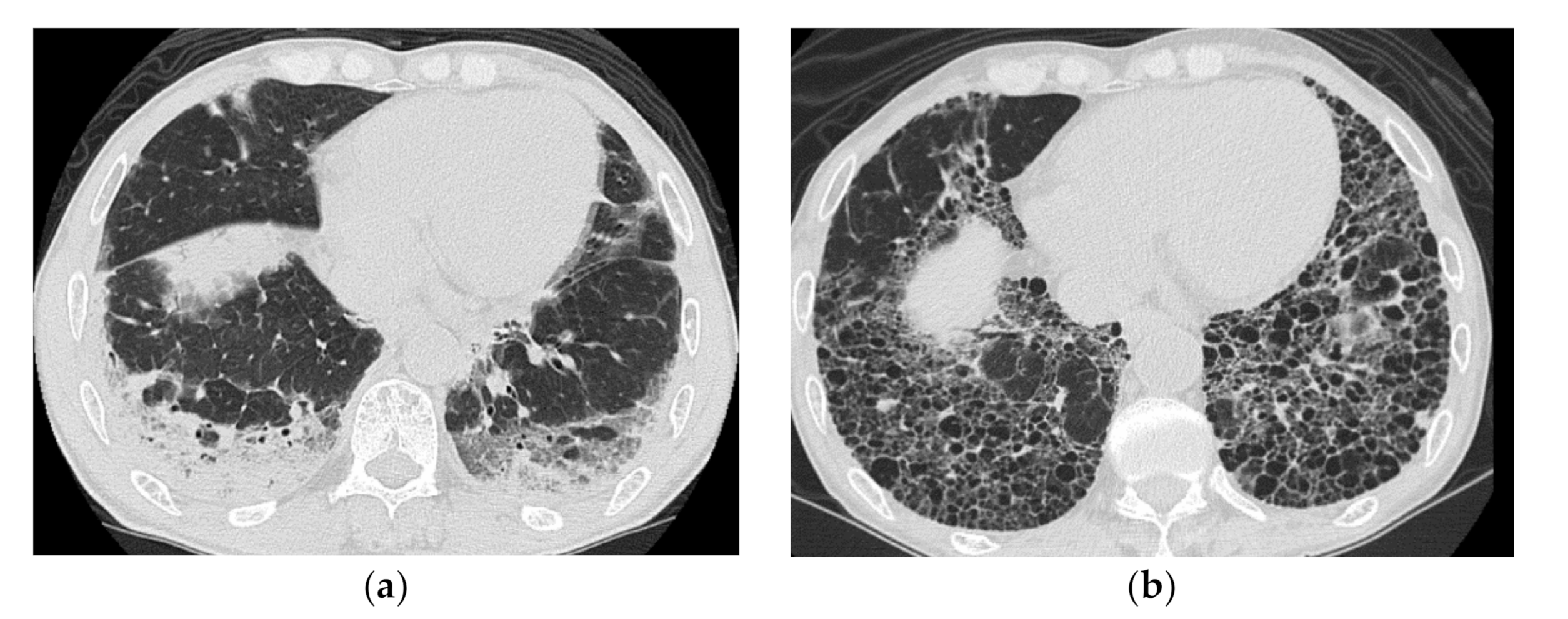 Interstitial Lung Disease X Ray