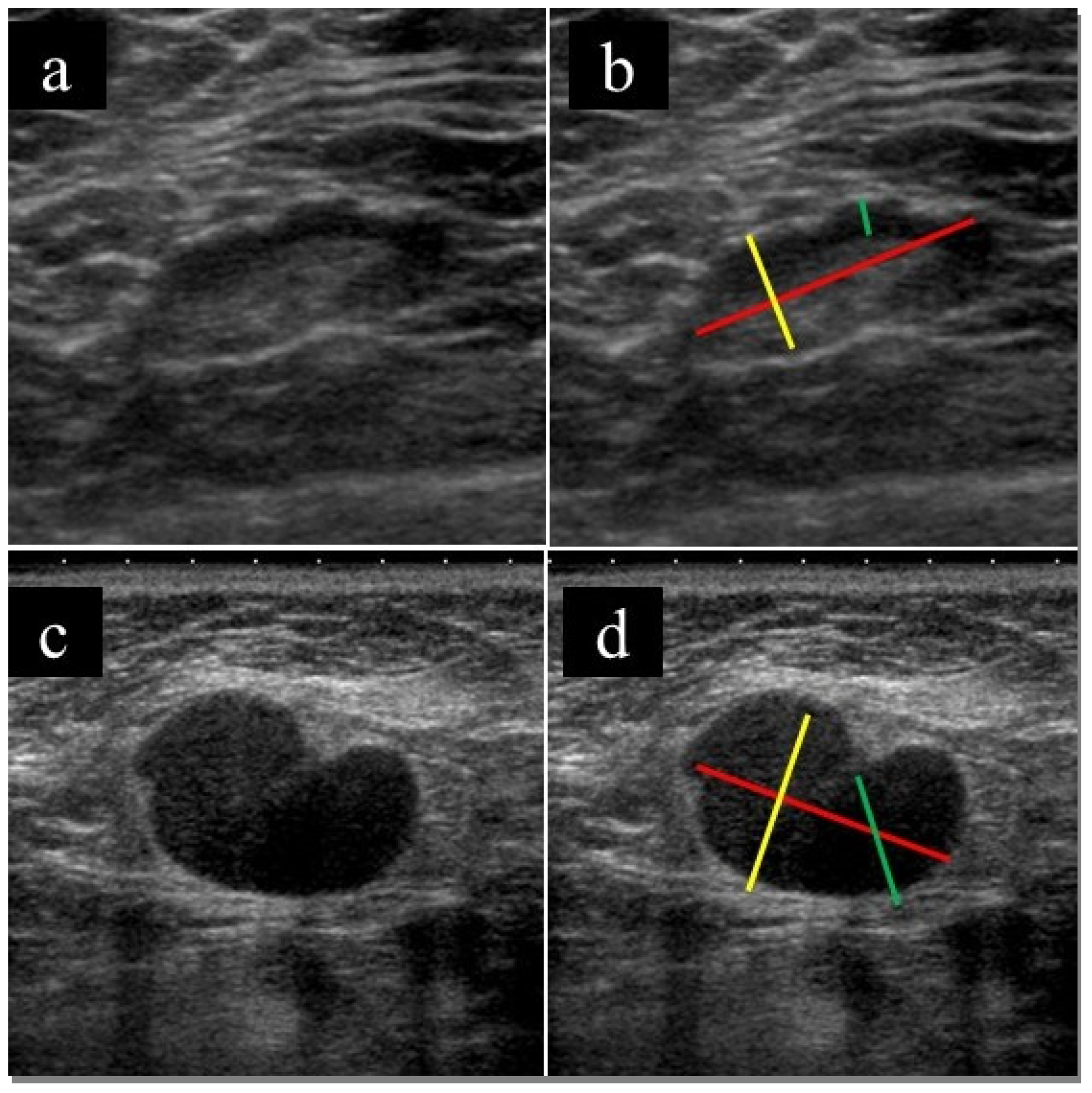 Medicina Free Full-Text Clinical Usefulness of Ultrasound-Guided Fine Needle Aspiration and Core Needle Biopsy for Patients with Axillary Lymphadenopathy