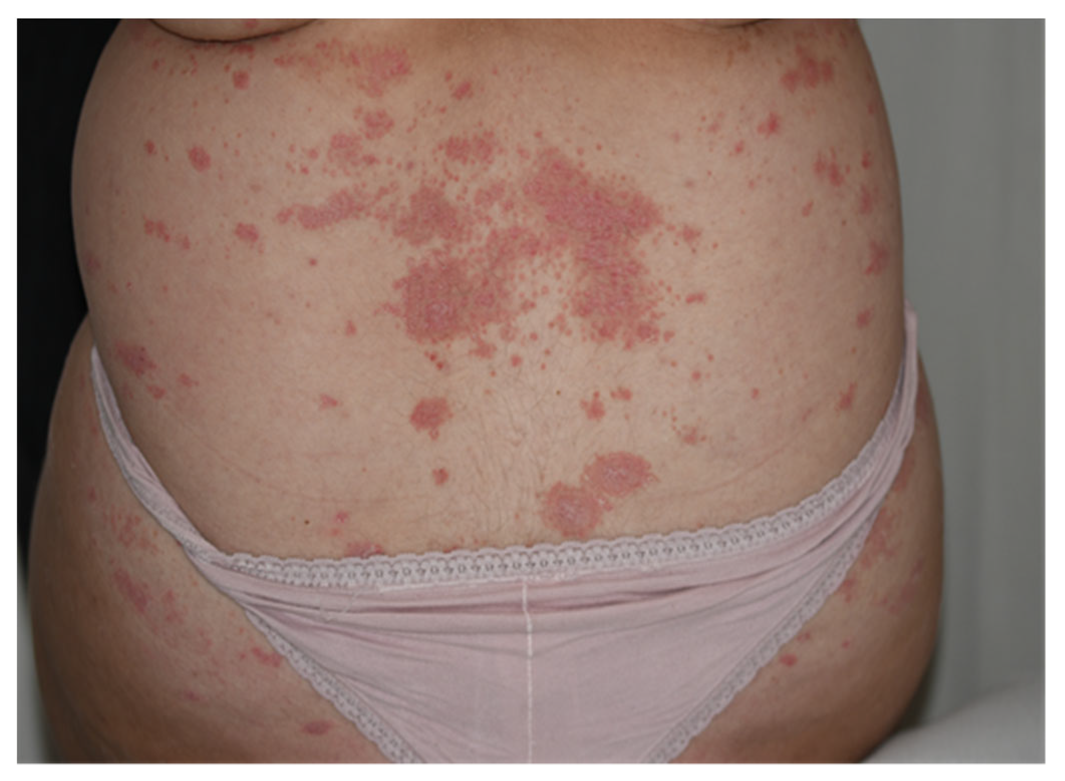 psoriasis in pregnancy first trimester)