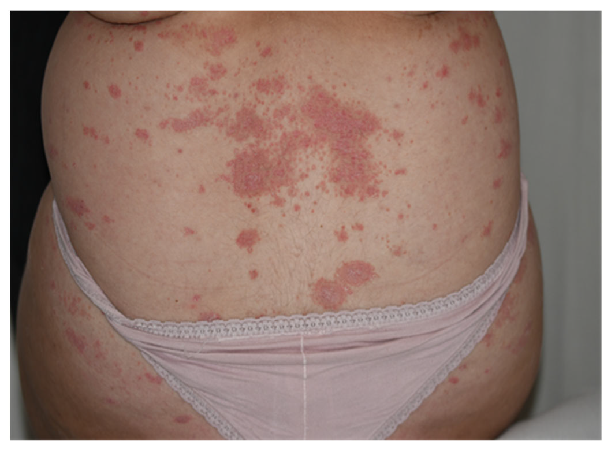 can you get psoriasis after pregnancy