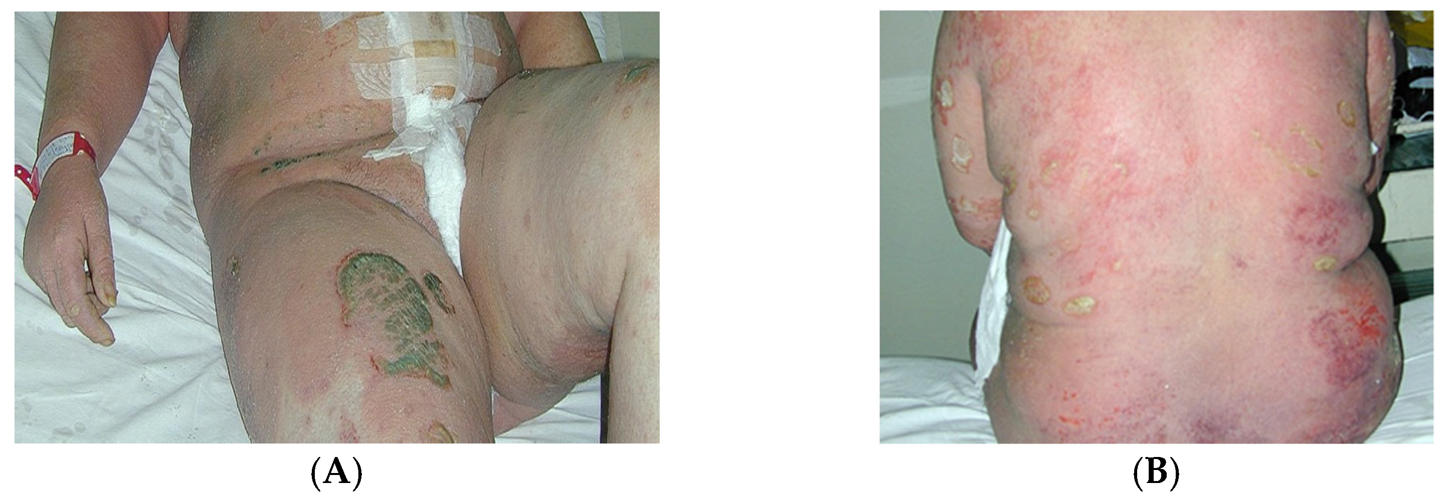 psoriasis remission during pregnancy)