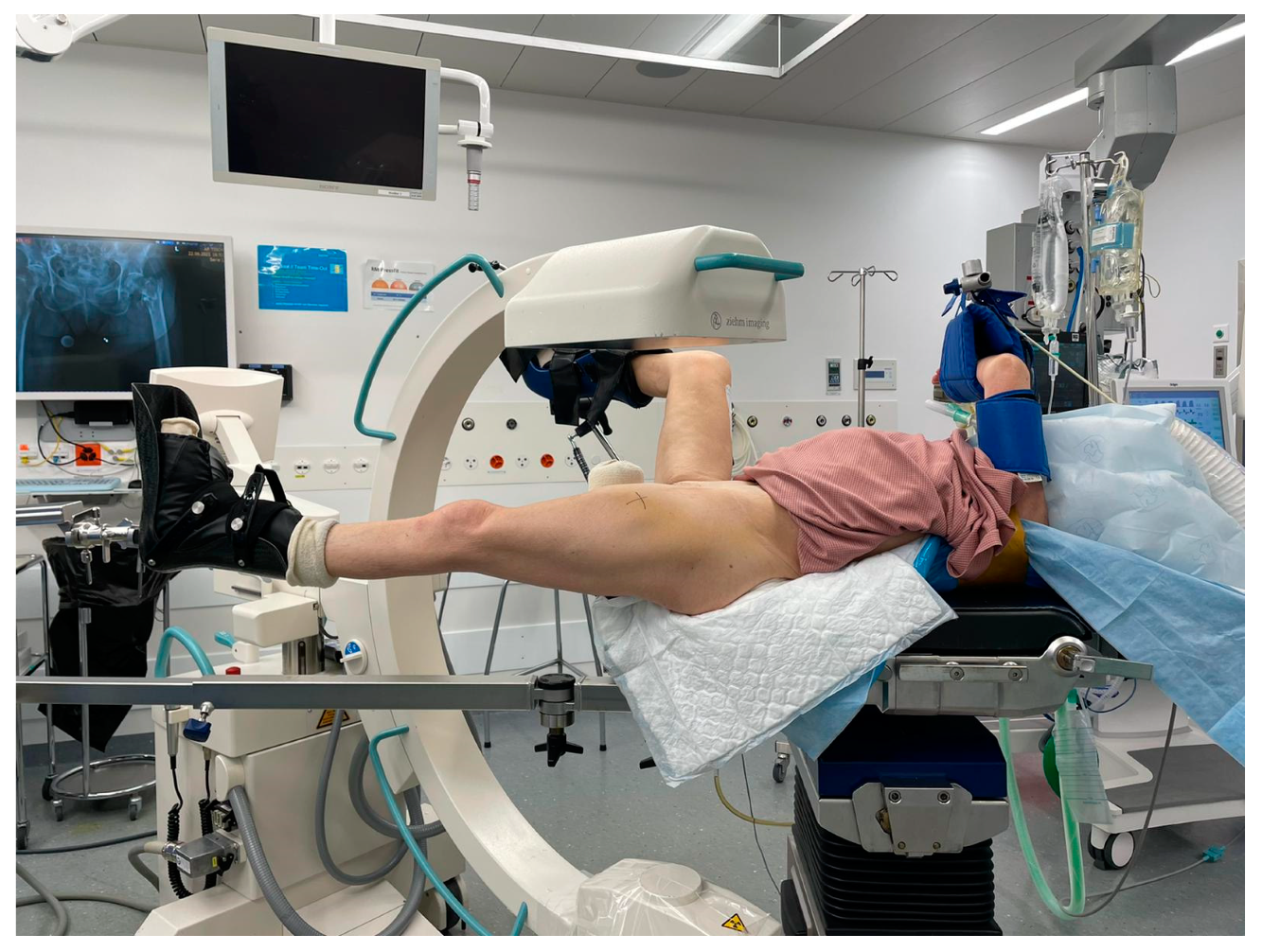 Medicina | Free Full-Text | Trochanteric Femur Fractures: Application of Skeletal  Traction during Surgery Does Not Alter Soft-Tissue Microcirculation