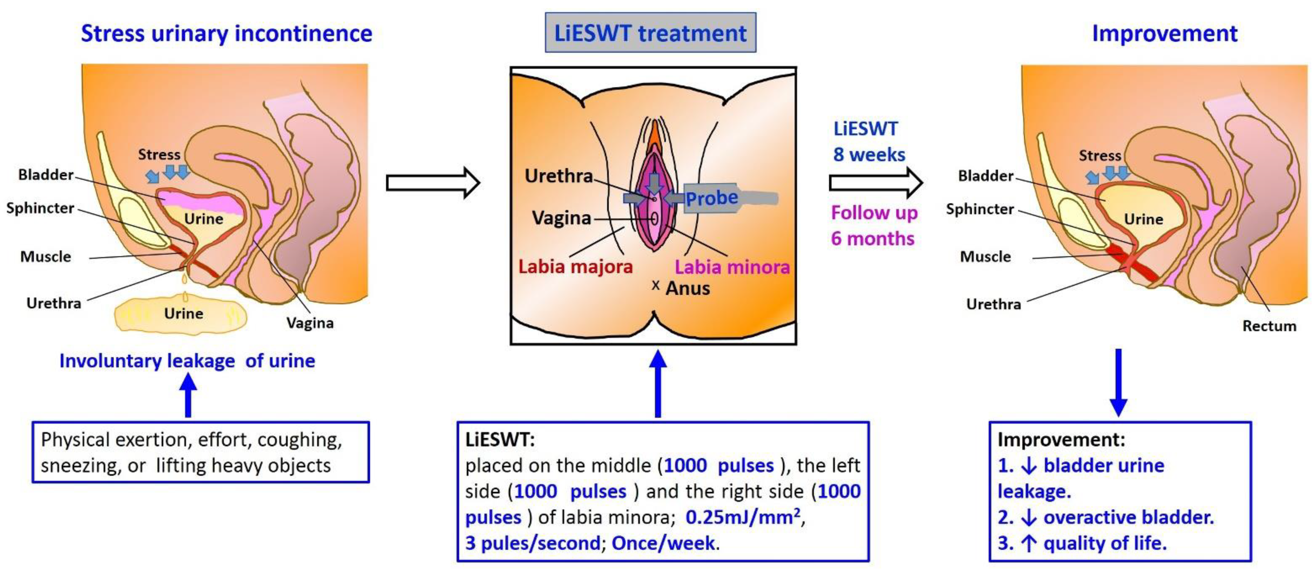 Urine leakage treatment deals