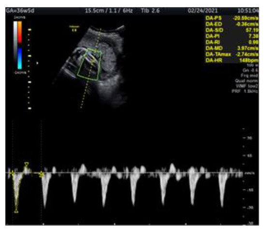 Doppler Ultrasonography of the Fetal Tibial Artery in High-Risk ...