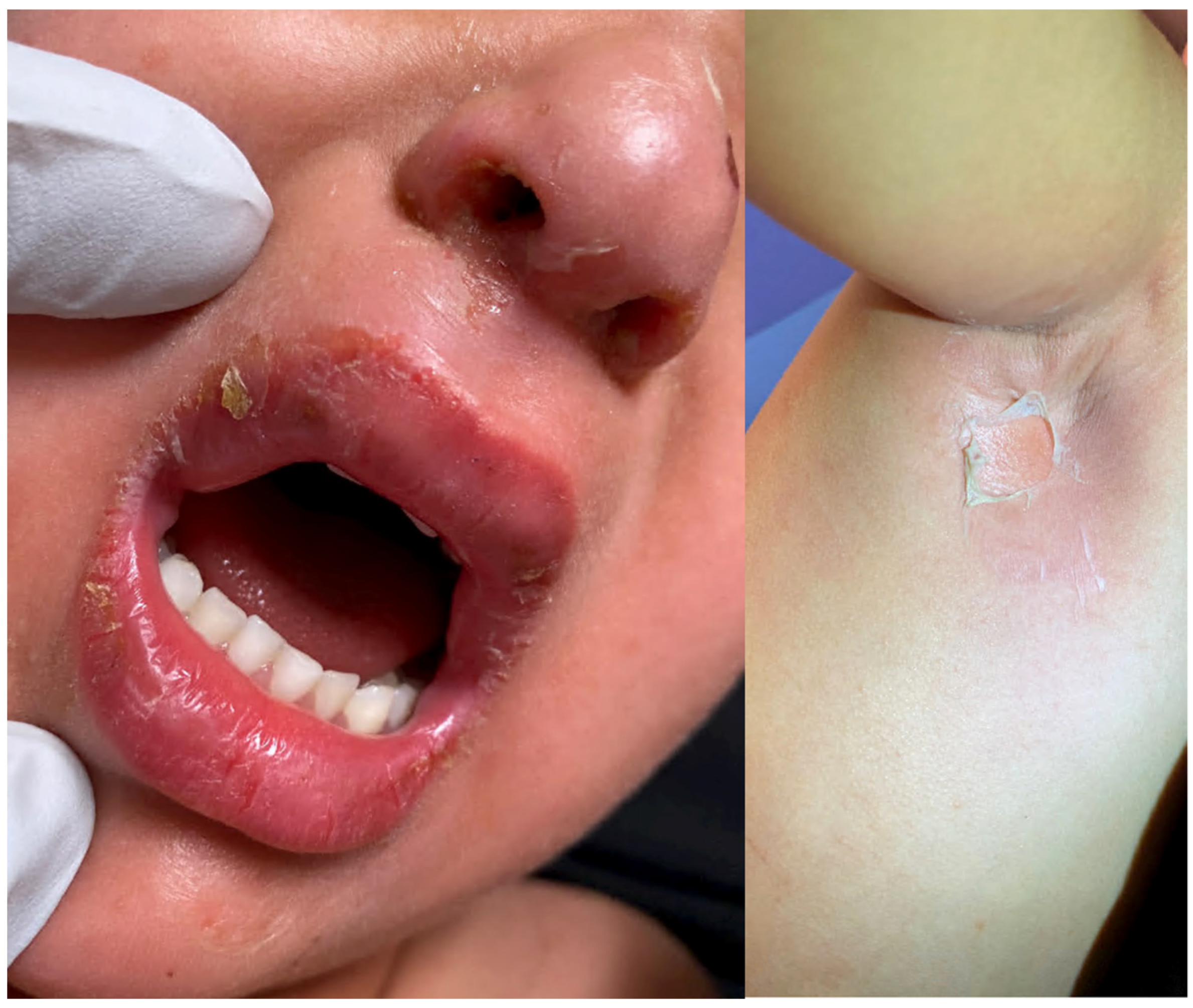 bullous impetigo in children