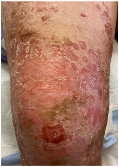 Pustules on the back possibly triggering toxic-shock syndrome