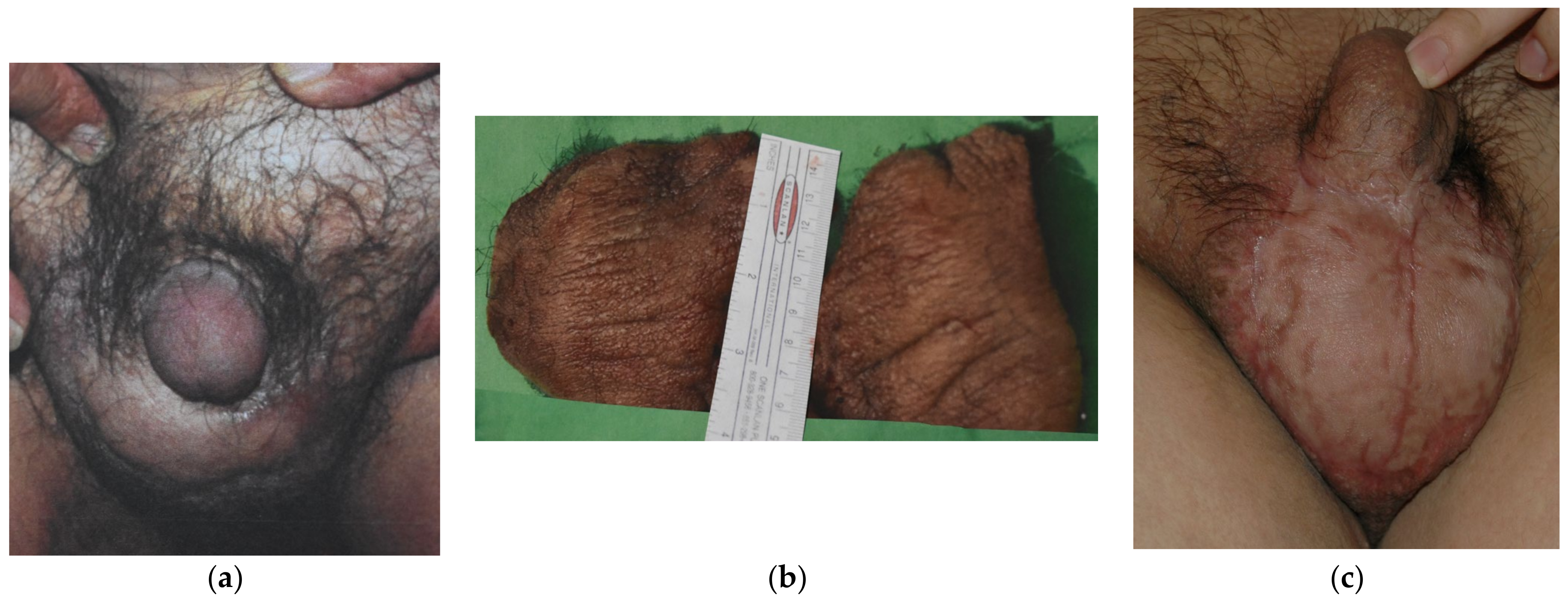 Medicina | Free Full-Text | Genital Lymphedema and How to Deal with It:  Pearls and Pitfalls from over 38 Years of Experience with Unusual Lymphatic  System Impairment