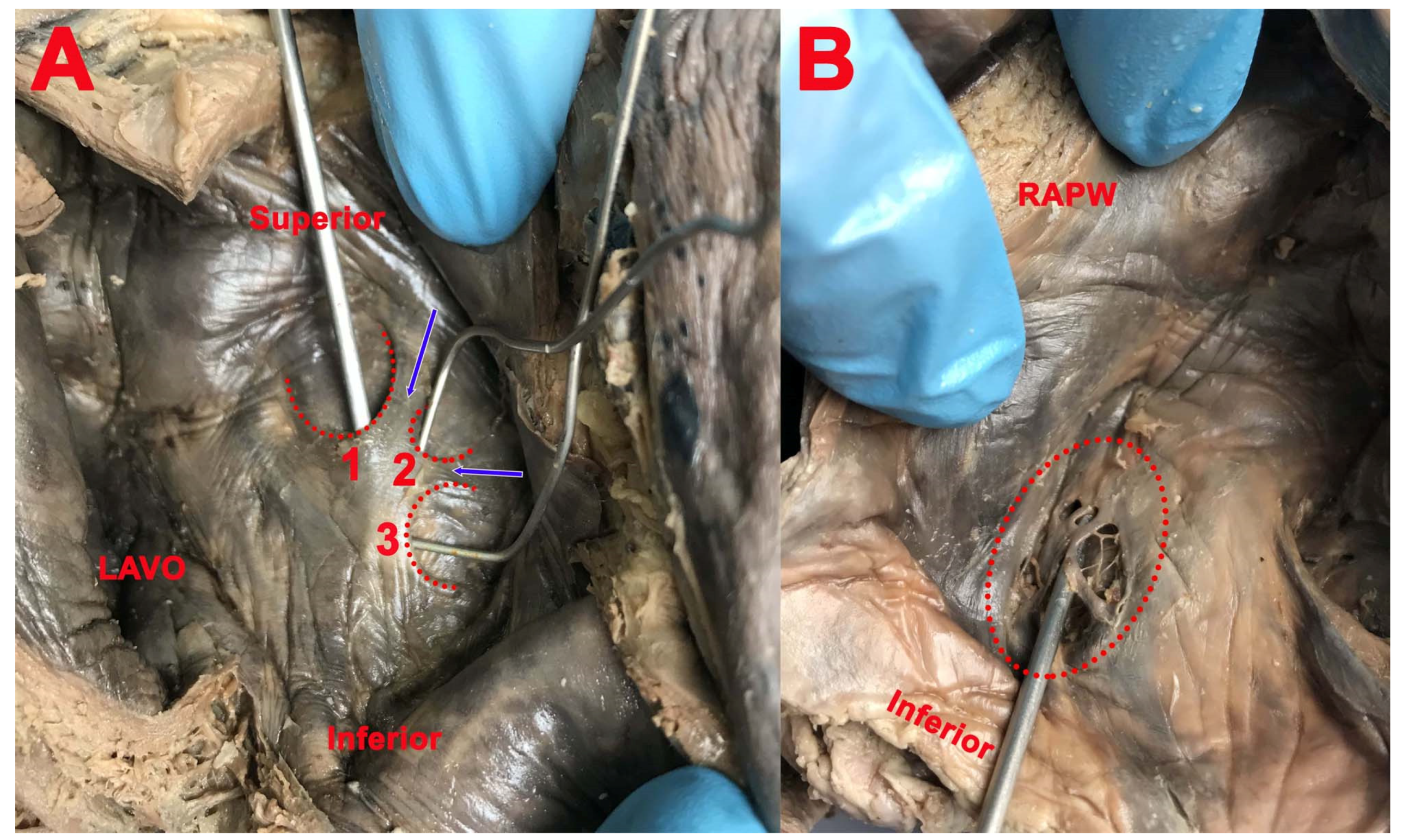 The Surgical Considerations Of The Fossa Ovalis - Healthsoothe