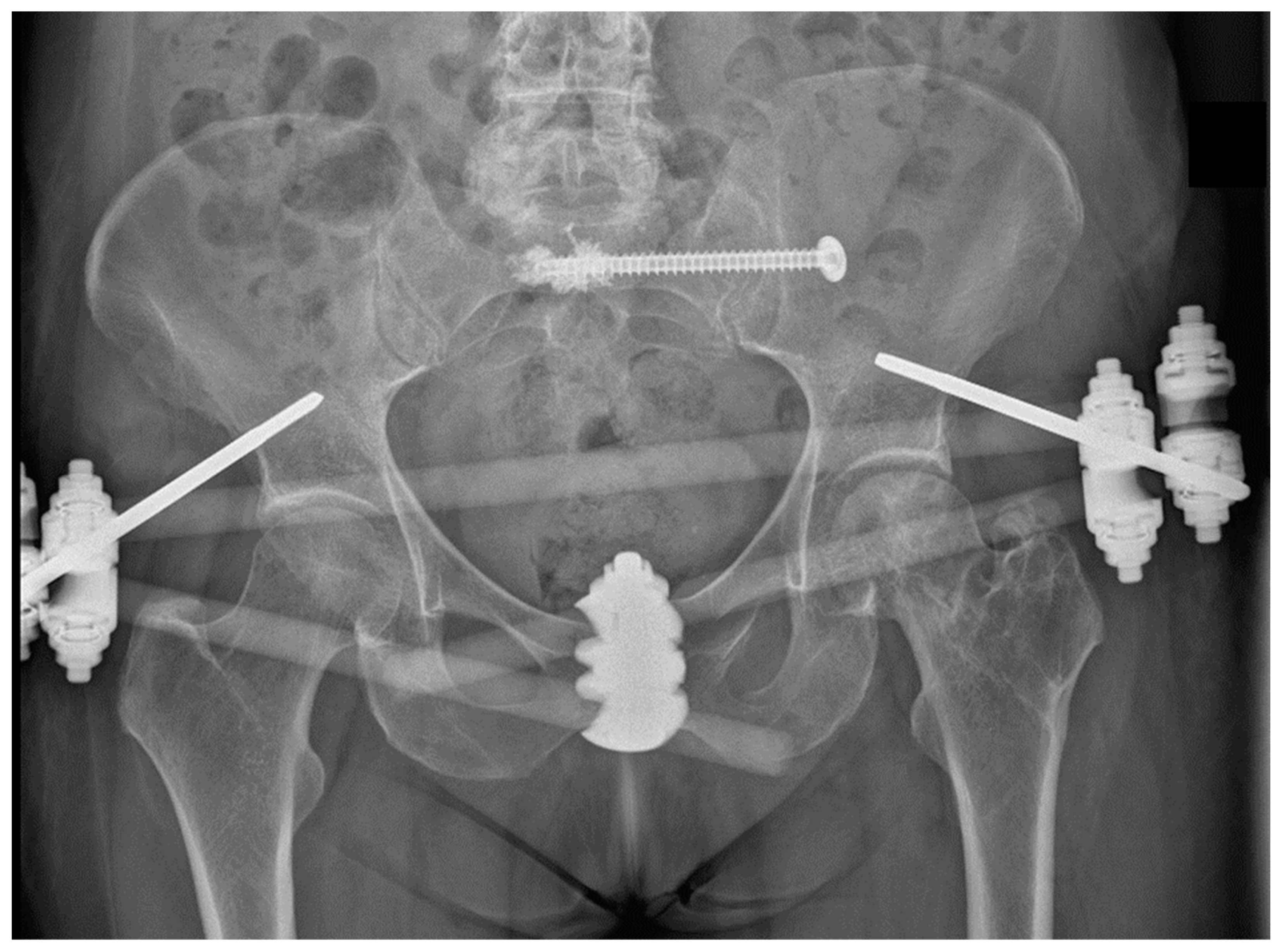 Major pelvic fractures. - Document - Gale Academic OneFile
