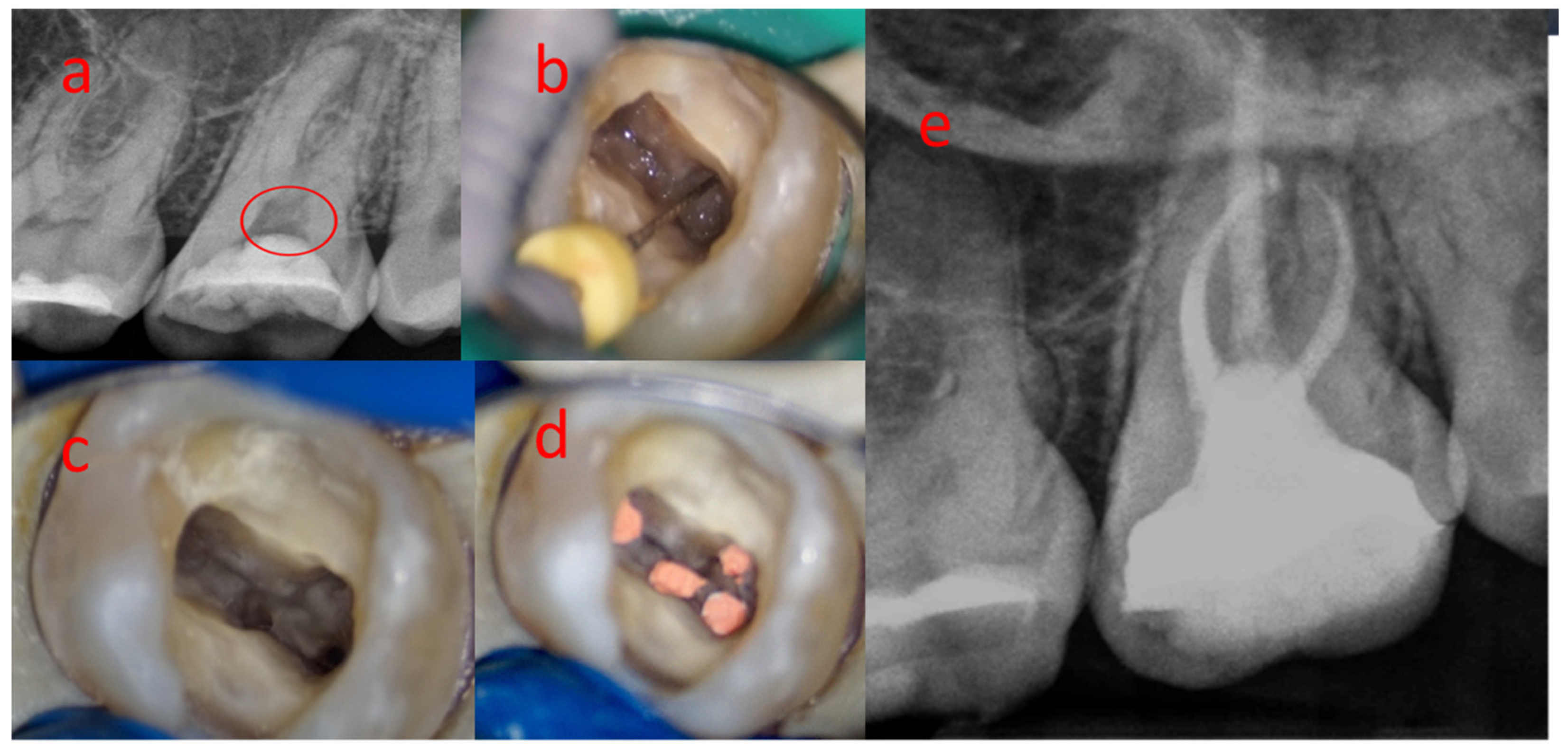 calcified pulp chamber