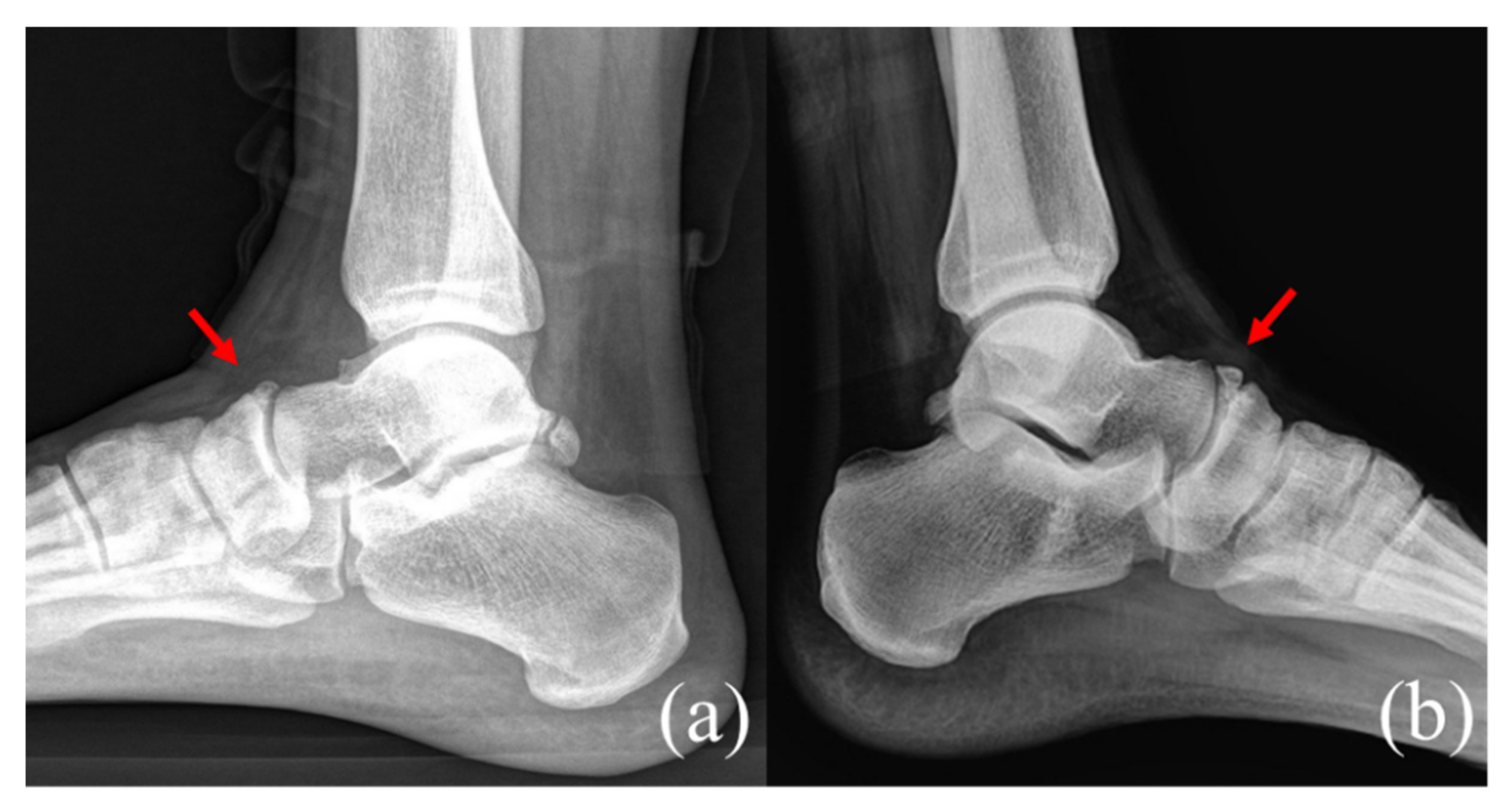 Bone navicular Accessory Navicular