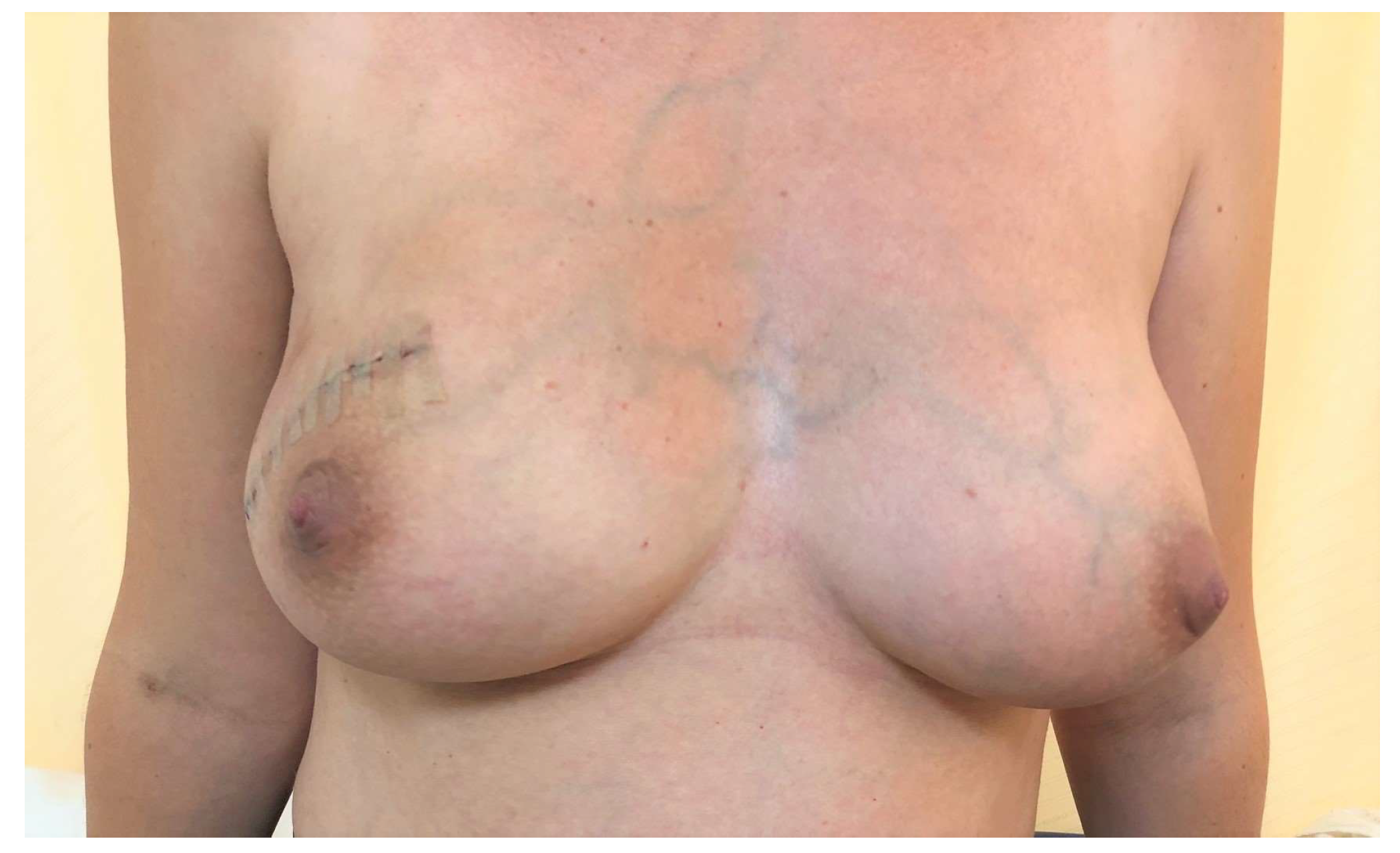 amateur milf forum breast reconstruction from Xxx Pics Hd