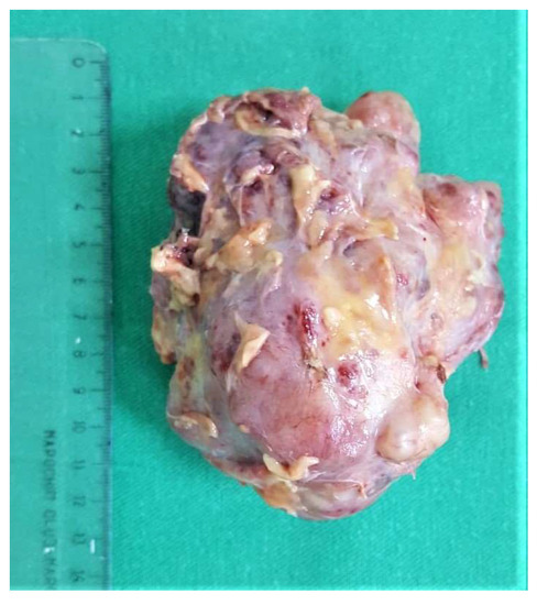 phylloides tumor breast boy and housewife