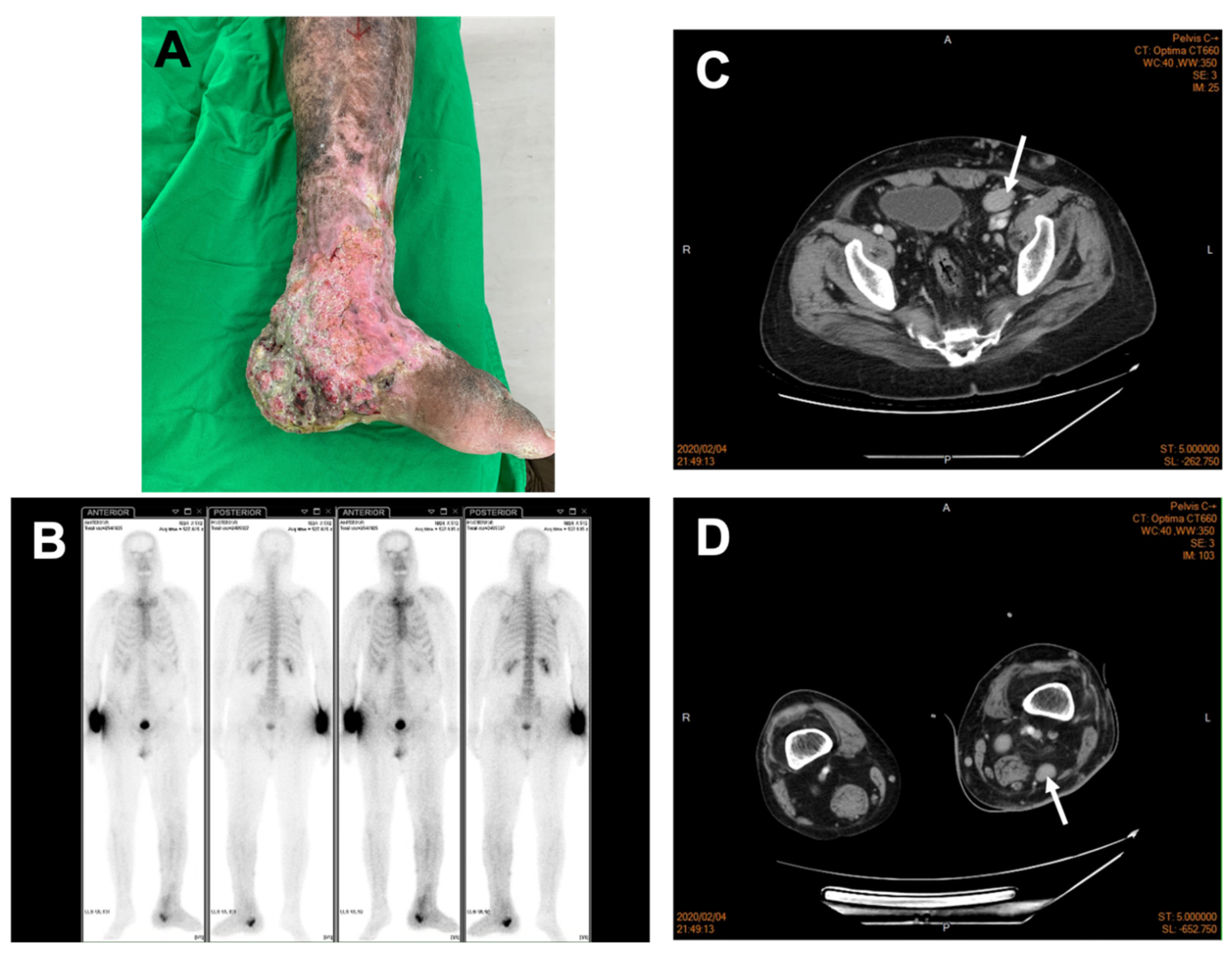 Medicina | Free Full-Text | of Marjolin&rsquo;s Ulcer in the Lower Limb in a Patient with Idiopathic Multicentric Castleman Disease: A Case