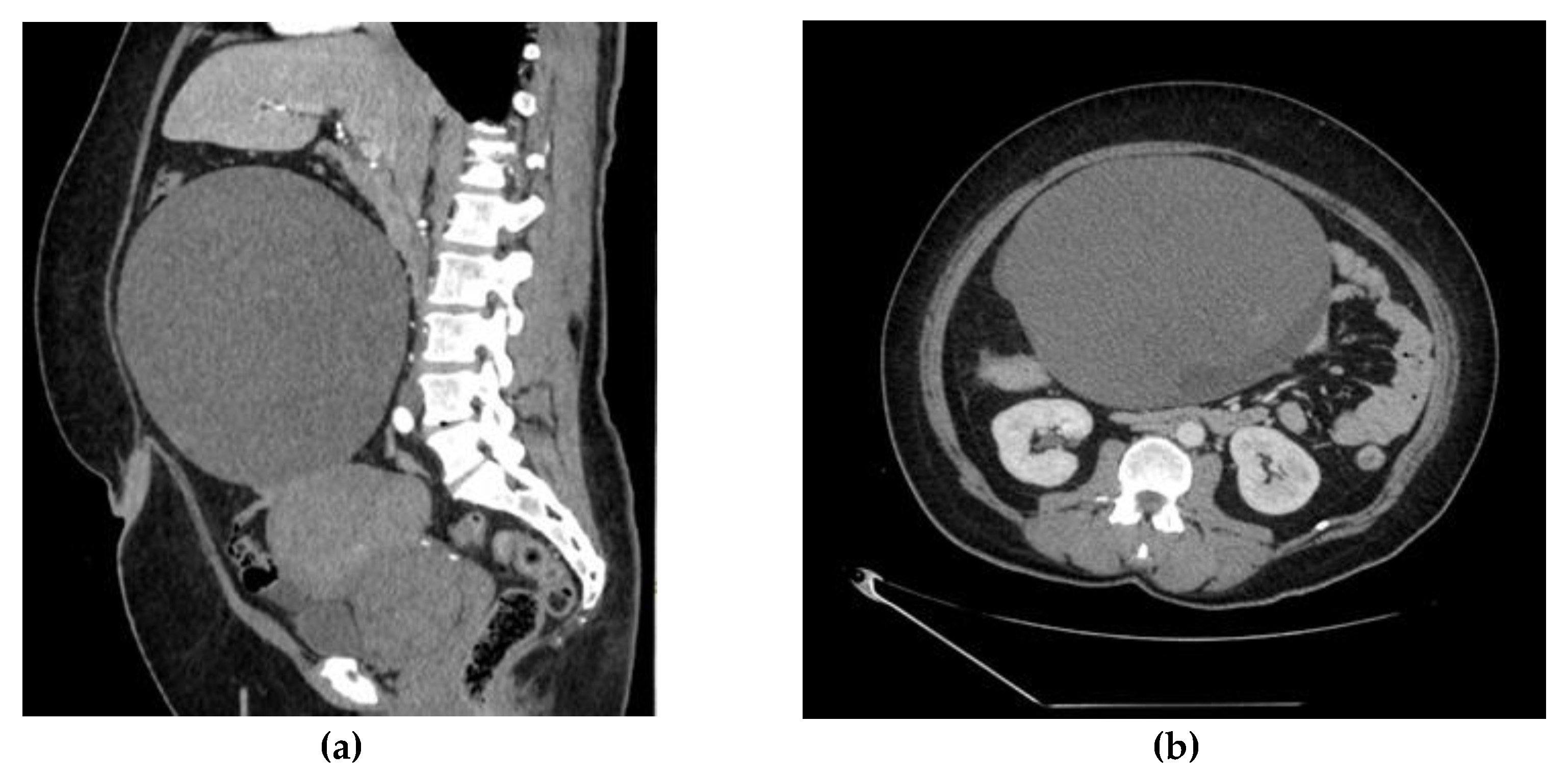 Medicina | Free Full-Text | Acute of Large Size Clear Cell Ovarian Carcinoma as Double Torsed Tumor
