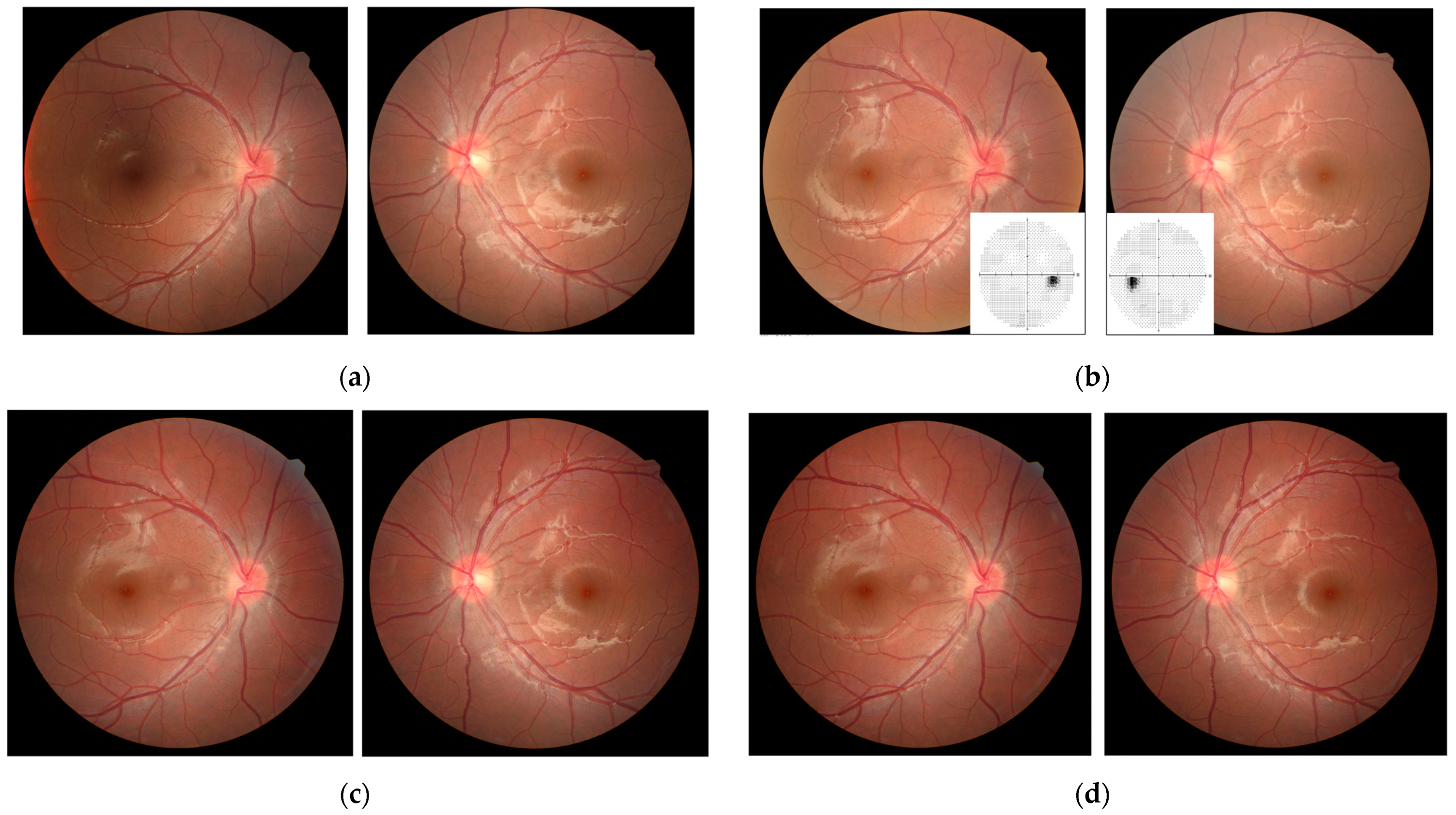 Medicina | Free Full-Text | Delayed Onset Bilateral Papilledema in a Young  Boy&rsquo;s Eyes after Trauma