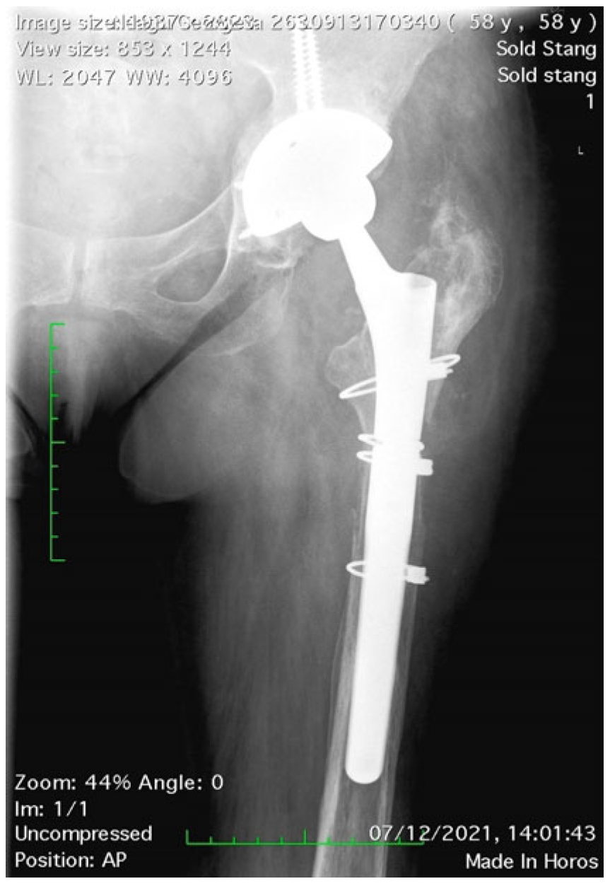Medicina | Free Full-Text | Transfemoral Approach in Revision Hip