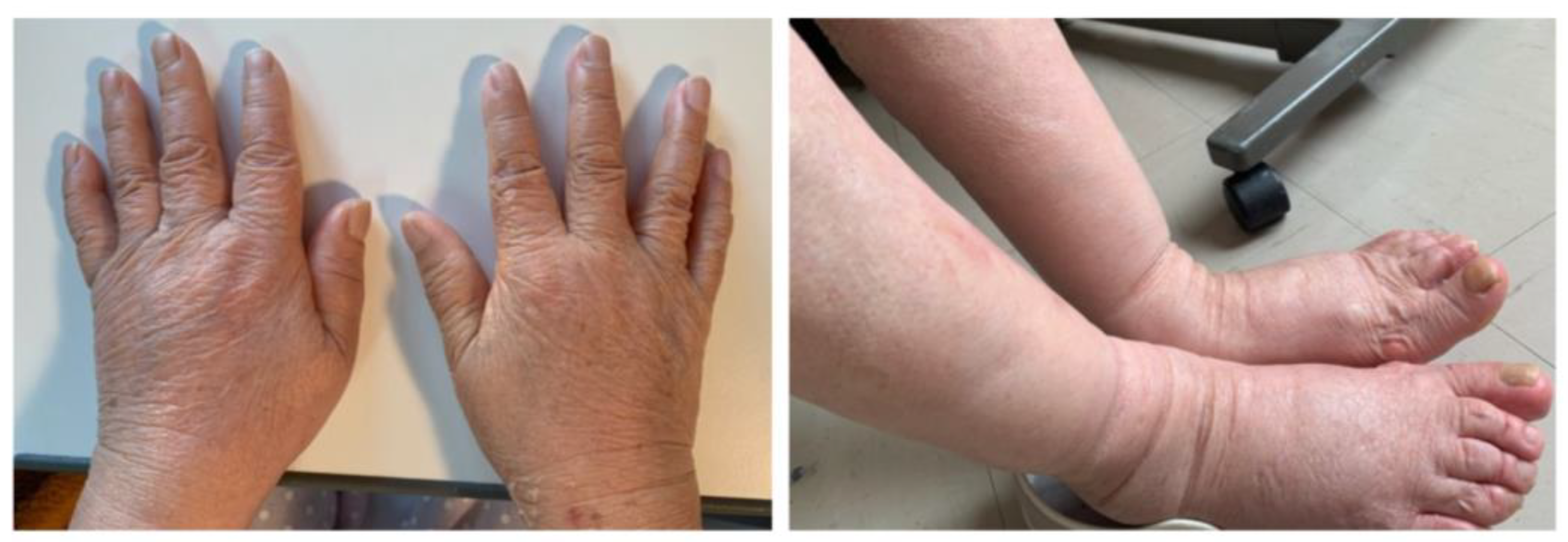 Pitting Edema Scale 1 4