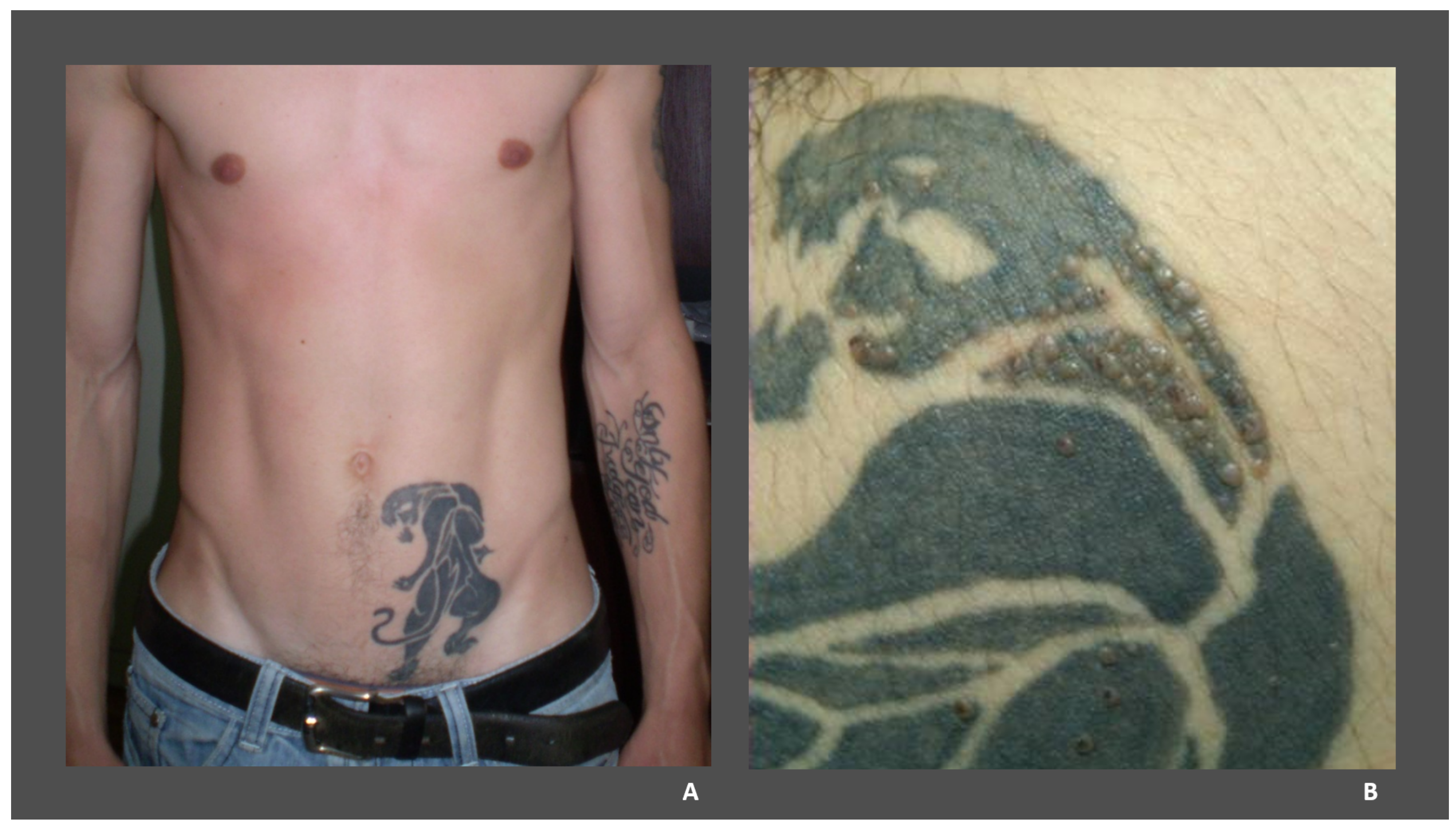 Medicina | Free Full-Text | Viral Infections Confined to Tattoos—A  Narrative Review