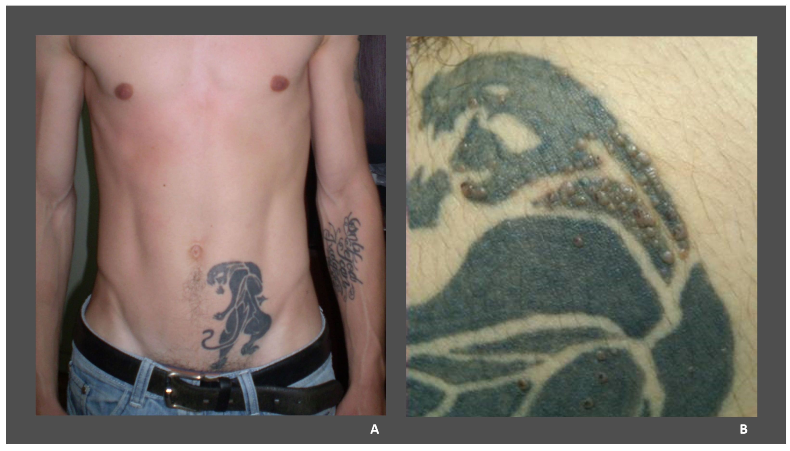 Laser Tattoo Removal: The Most Common Misconceptions