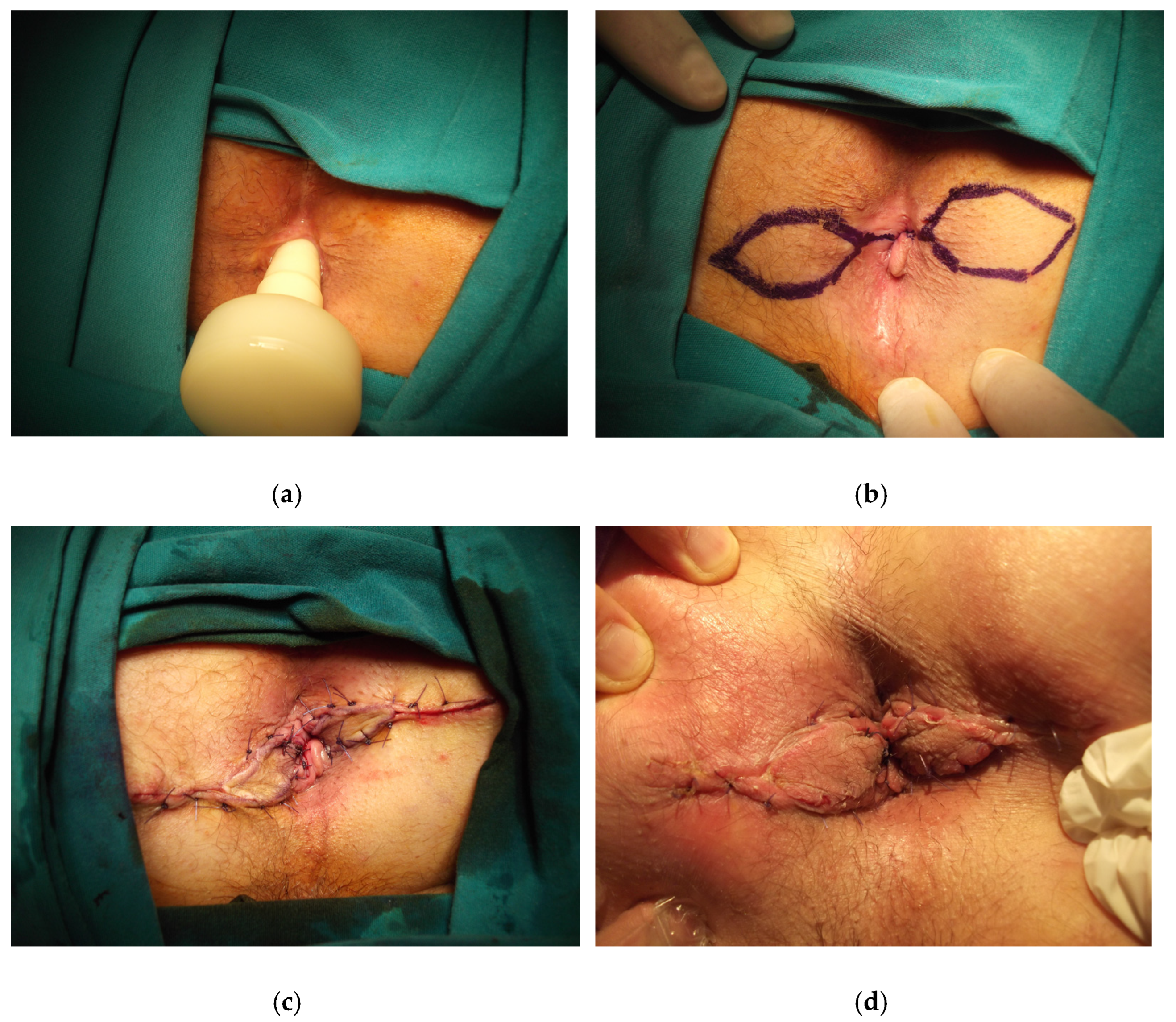 before and after anal  Anal Skin Tags Lake Success, Queens, Long Island NY