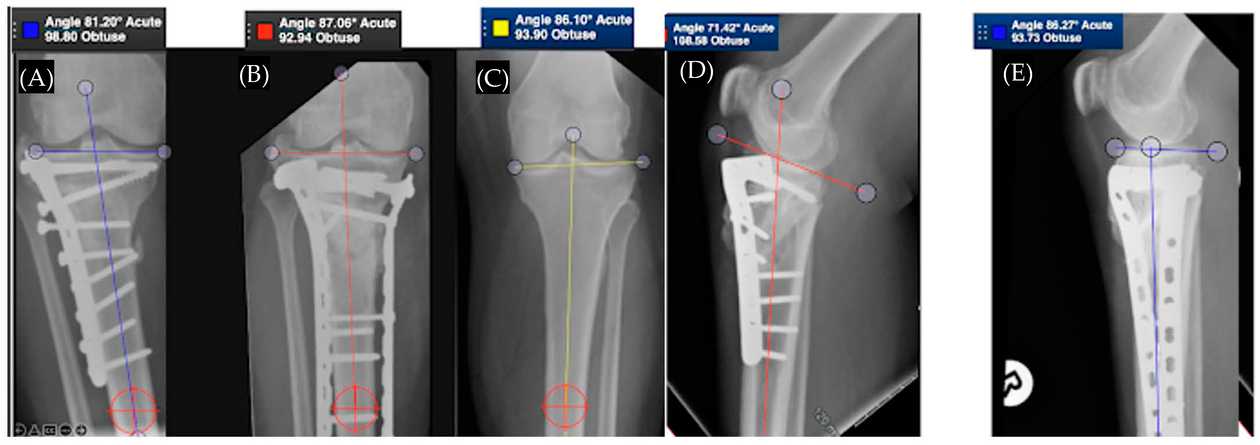Medicina Free Full Text Malunion Of The Tibia A Systematic Review