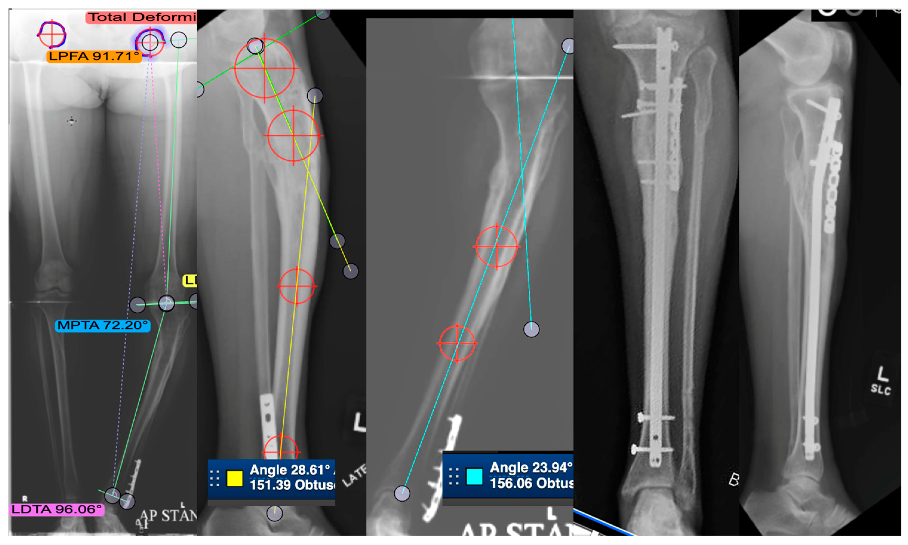 Full ring external fixation (Ilizarov) for Extraarticular, wedge