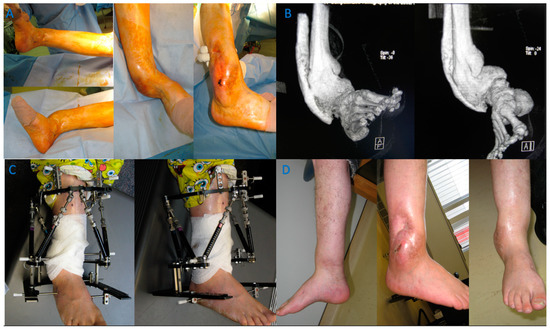 Circular external fixator application for midshaft tibial