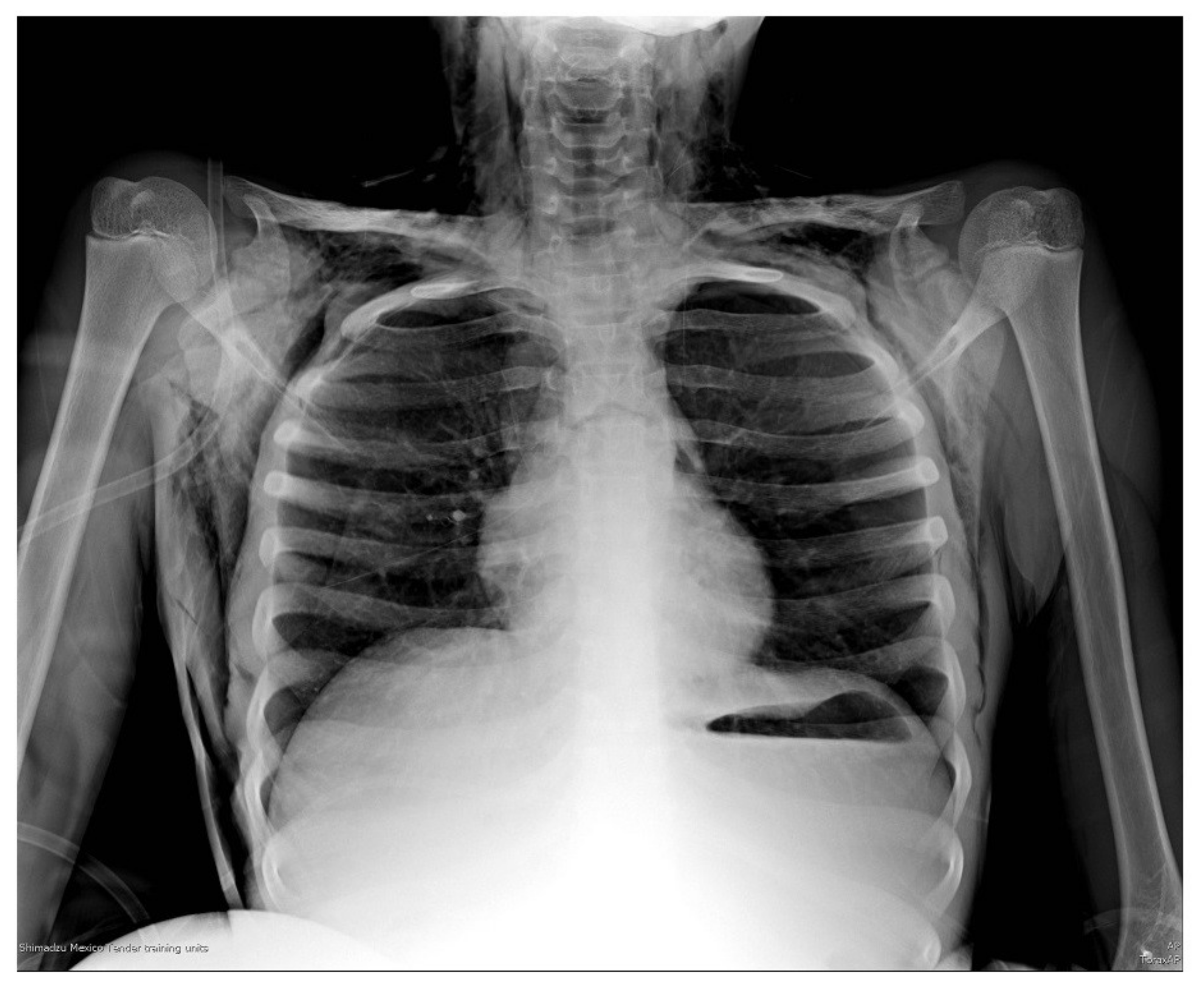 Successful Management Foreign Body Aspiration Associated with Severe